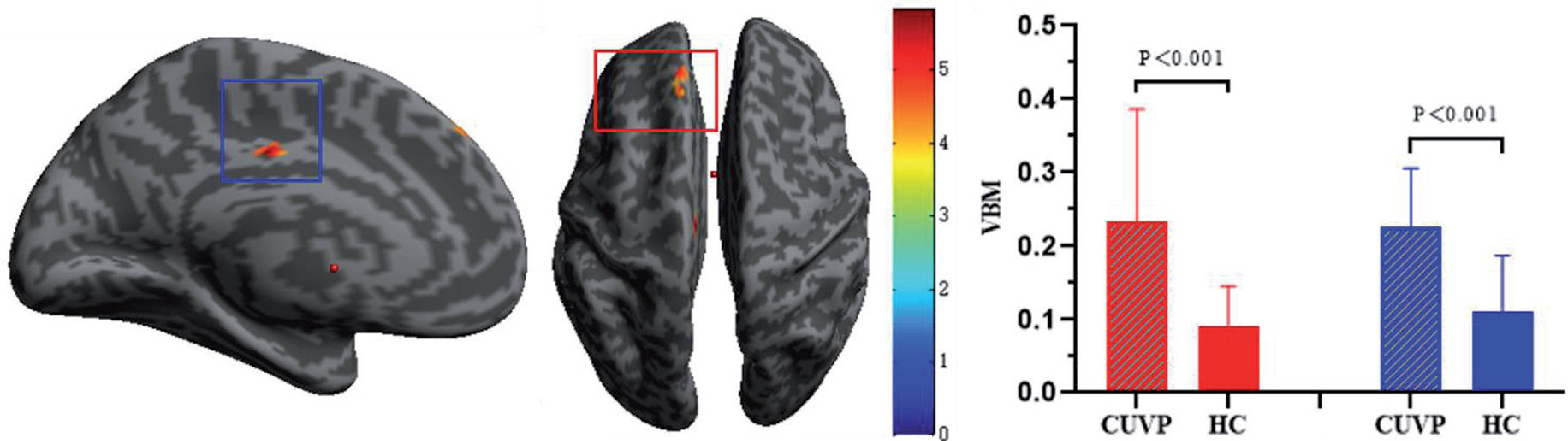 The gray matter volume in the left medial superior frontal gyrus and left middle cingulate gyrus was signifi cantly higher in patients with CUVP thant in HCs.