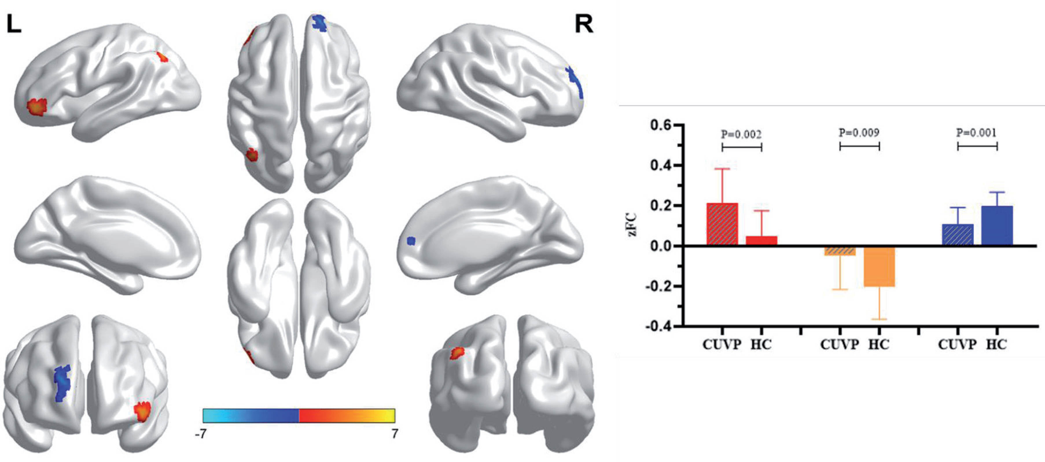 Patients with CUVP demonstrated enhanced FC between the left middle frontal gyrus and left orbital inferior frontal gyrus and left angular gyrus, weakened FC between the right dorsolateral superior frontal gyrus. Compared with healthy controls, the FC between left cingulate gyrus and the left cingulate gyrus was enhanced in patients with CUVP, which overlaps with the gray matter volume enhancement area.