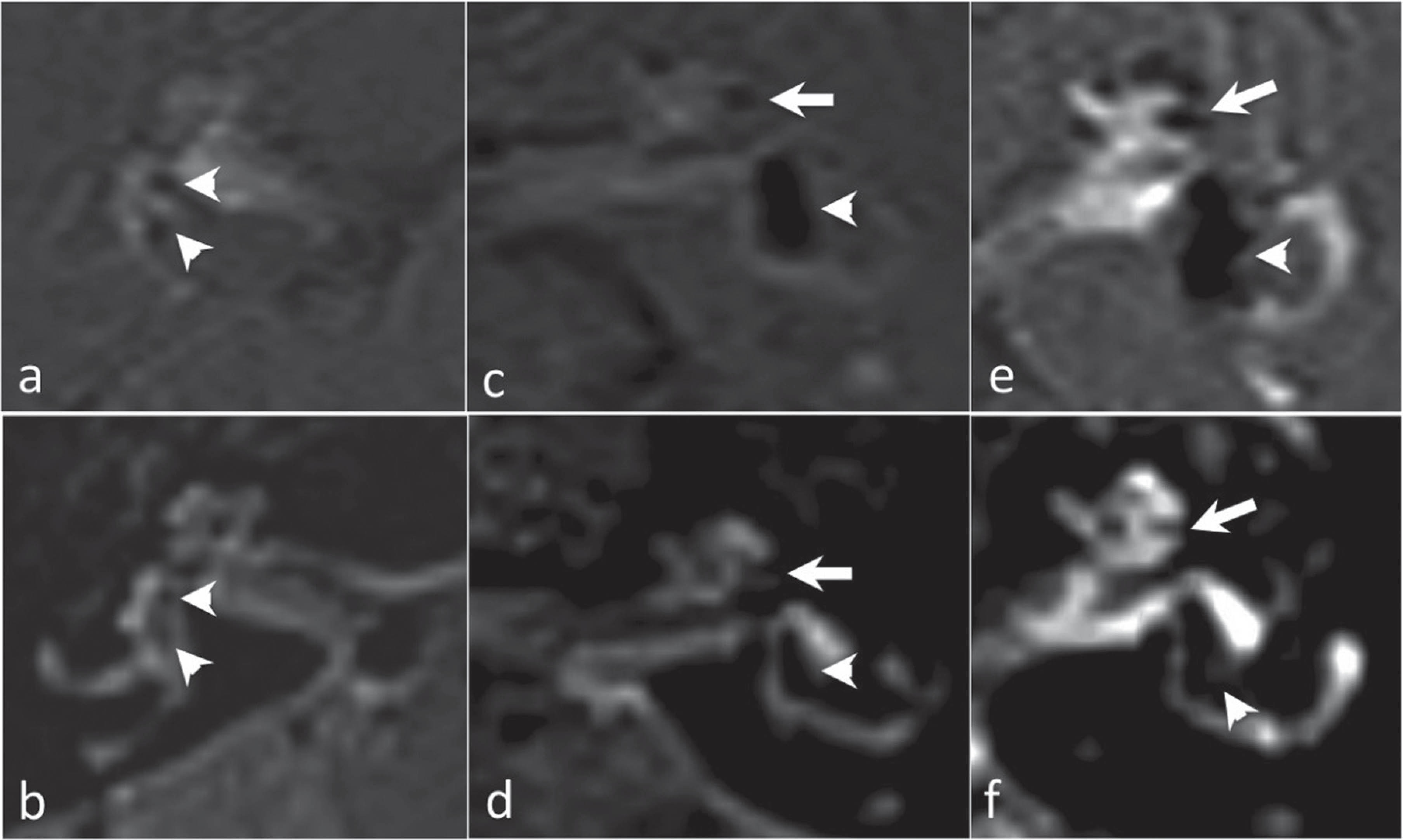 a,c,e, 3D-IR sequences. b,d,f, 3D-FLAIR sequences. No EH in a and b. The saccule and the utricle are depicted separately in the vestibule (arrowheads) and no signifi cative engorgement of the cochlear duct is detected.