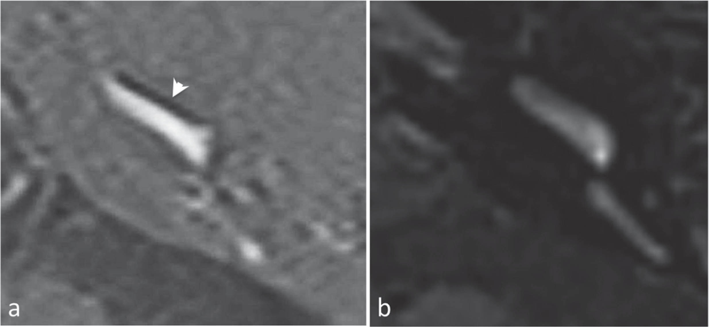 3D-IR sequence (a) and 3D-FALIR (b). Mild cochlear EH is clearly depicted on the 3D-IR (arrowhead) in a, as a dark smooth line corresponding to the mildly dilated cochlear duct. The contrast between the perilymph (high signal) and the surrounding bone (grey, intermediate signal) makes this diagnosis possible. On the contrary, when we analyze the 3D-FLAIR image in b, the surrounding bone -which is also low signal-, makes it almost impossible to distinguish the mild cochlear EH.