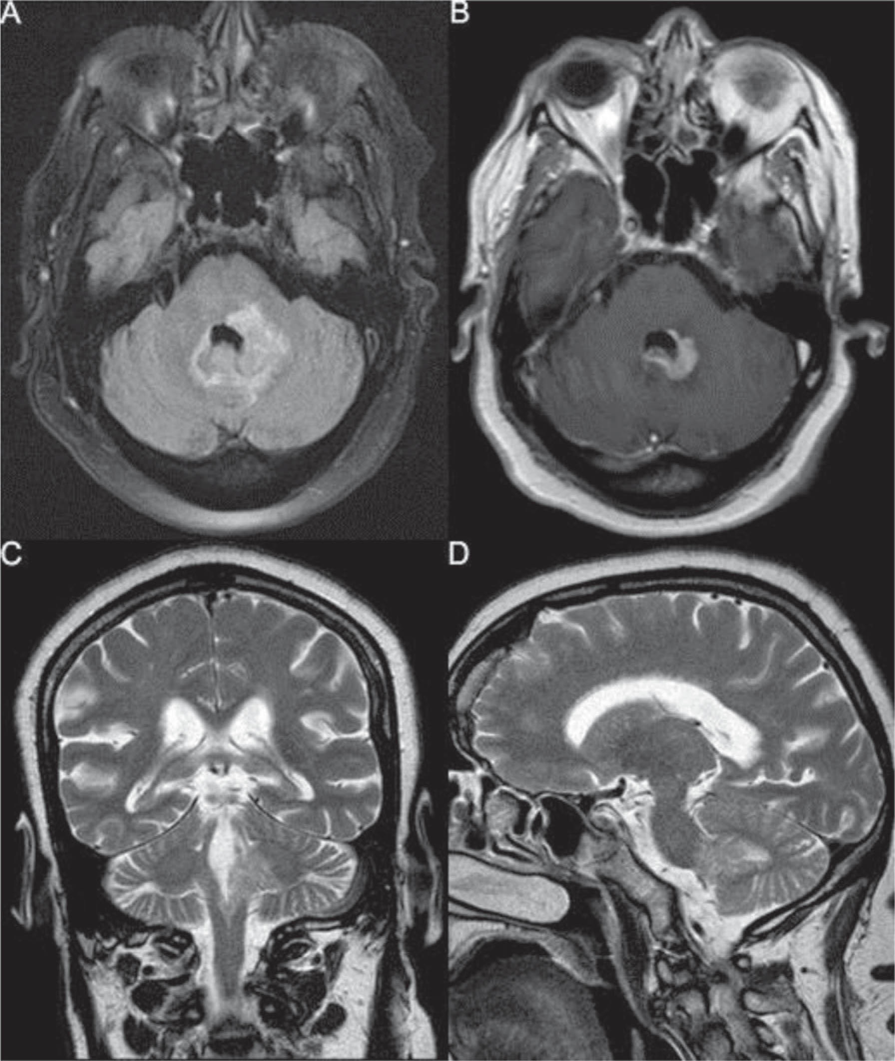 CNS Primary DLBCL on MRI.