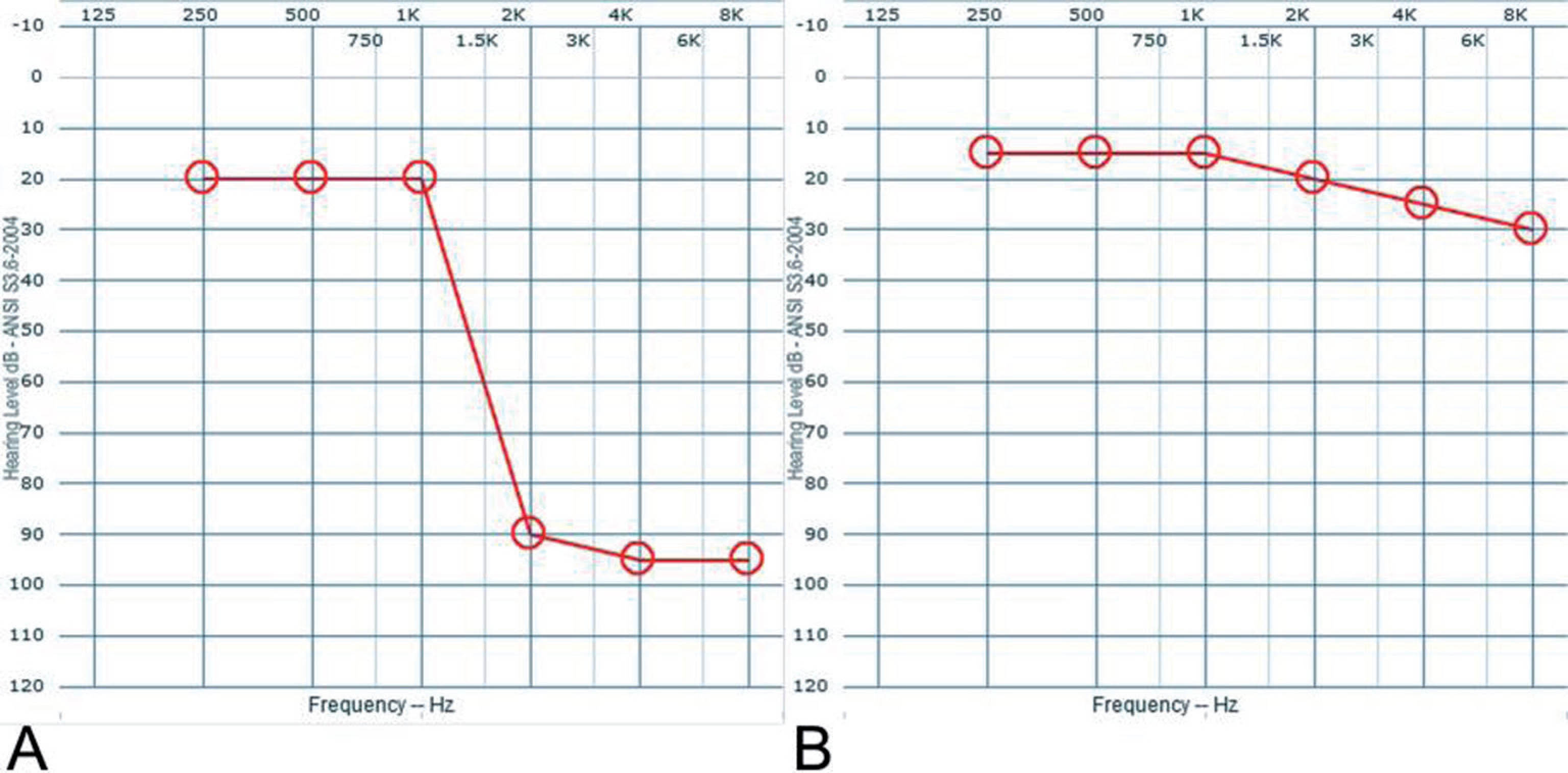 Right-ear pure tone audiograms. A – Initial audiogram; B – Post-treatment audiogram showing complete recovery of normal hearing levels.