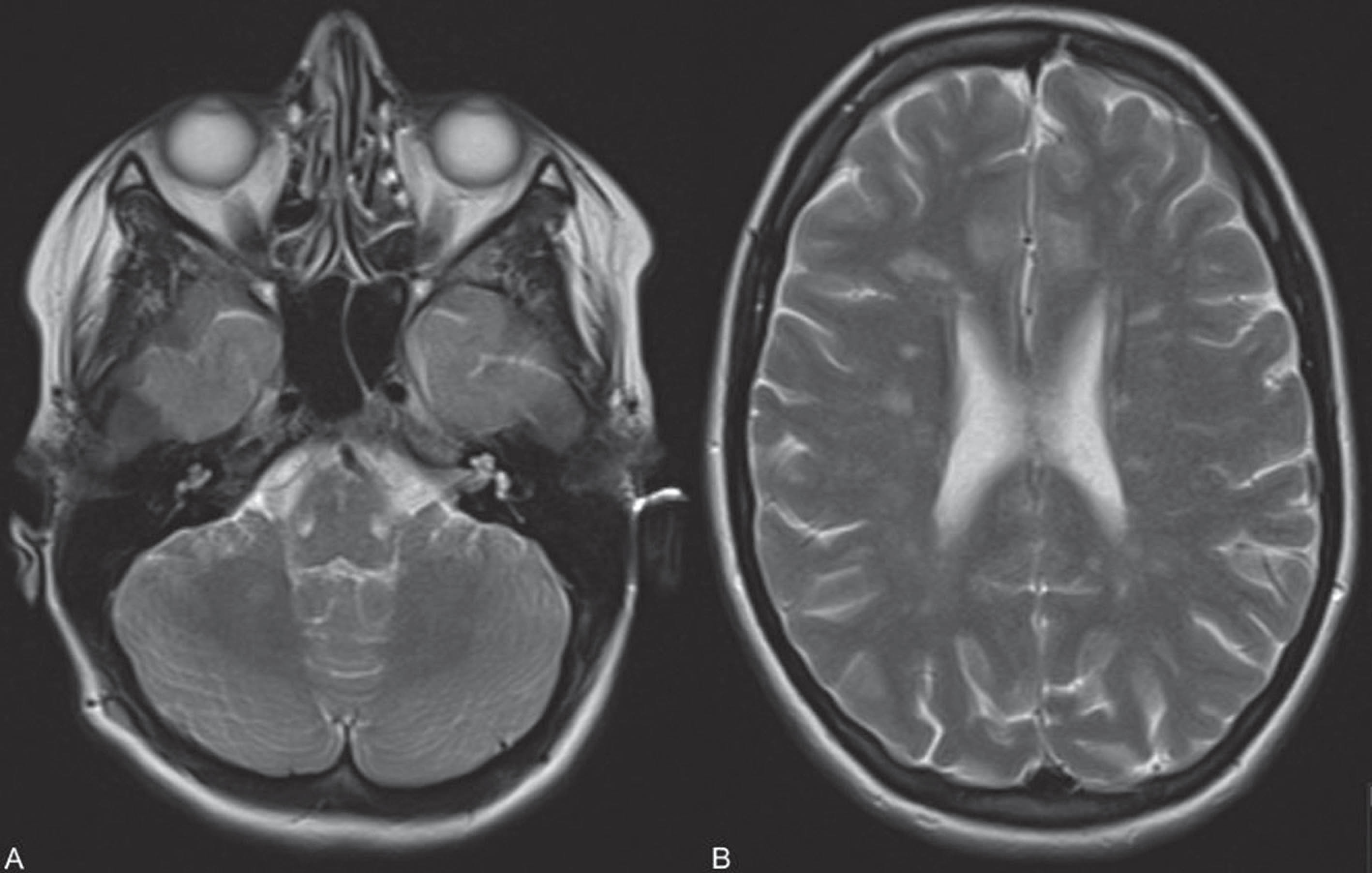 Brain MRI revealed multiple high-intensity lesions in a typical demyelinating disease topography including the right middle cerebellar peduncle (A) and the cerebellar hemisphere white matter (B).
