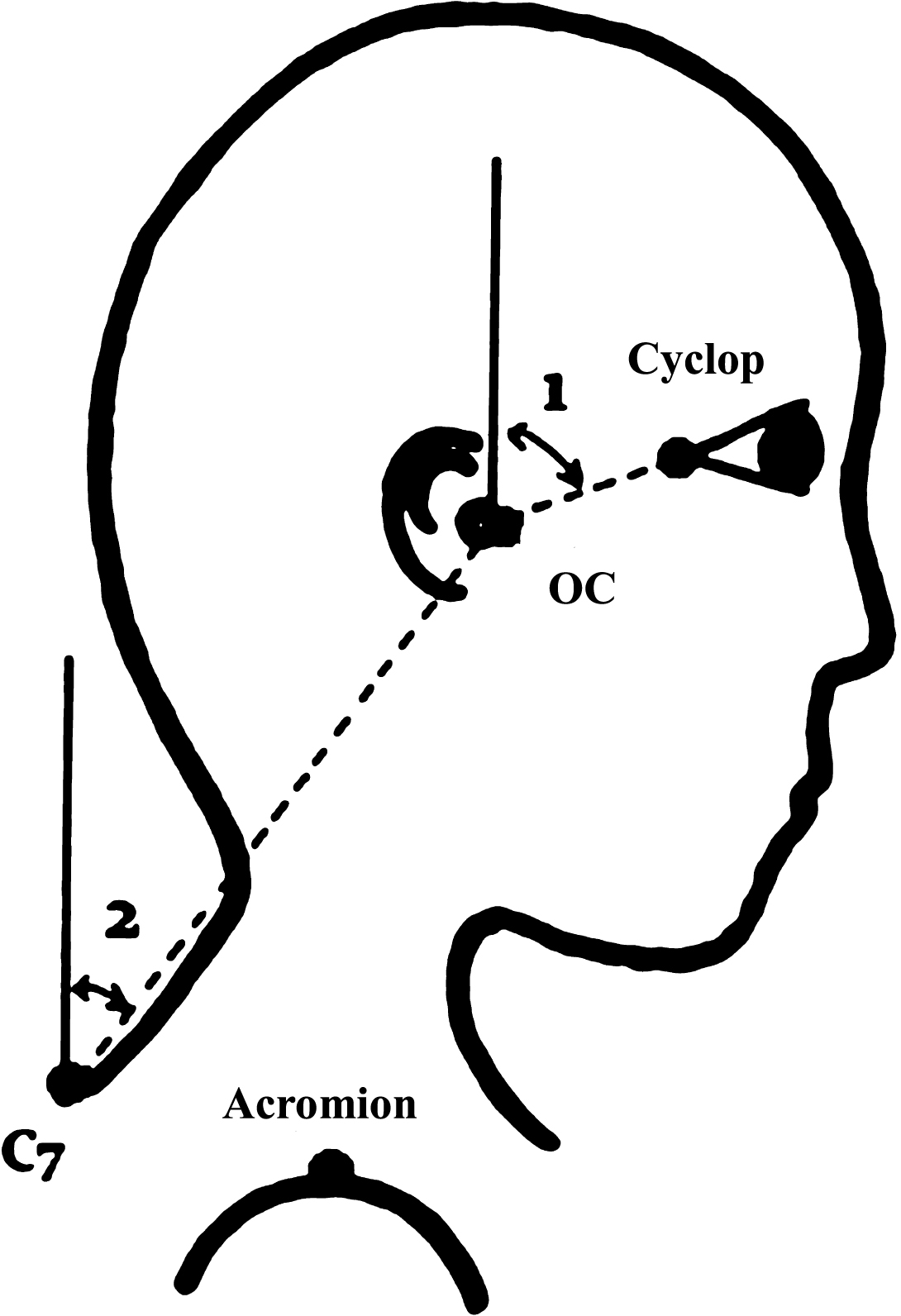 Head and neck flexion angles. Head flexion angle (1) is the angle between the global vertical and the vector pointing from occiput-cervical (OC) to Cyclops (midpoint between the left and right outer canthi), Neck flexion angle (2) is the angle between global vertical and vector pointing from C7 to OC.