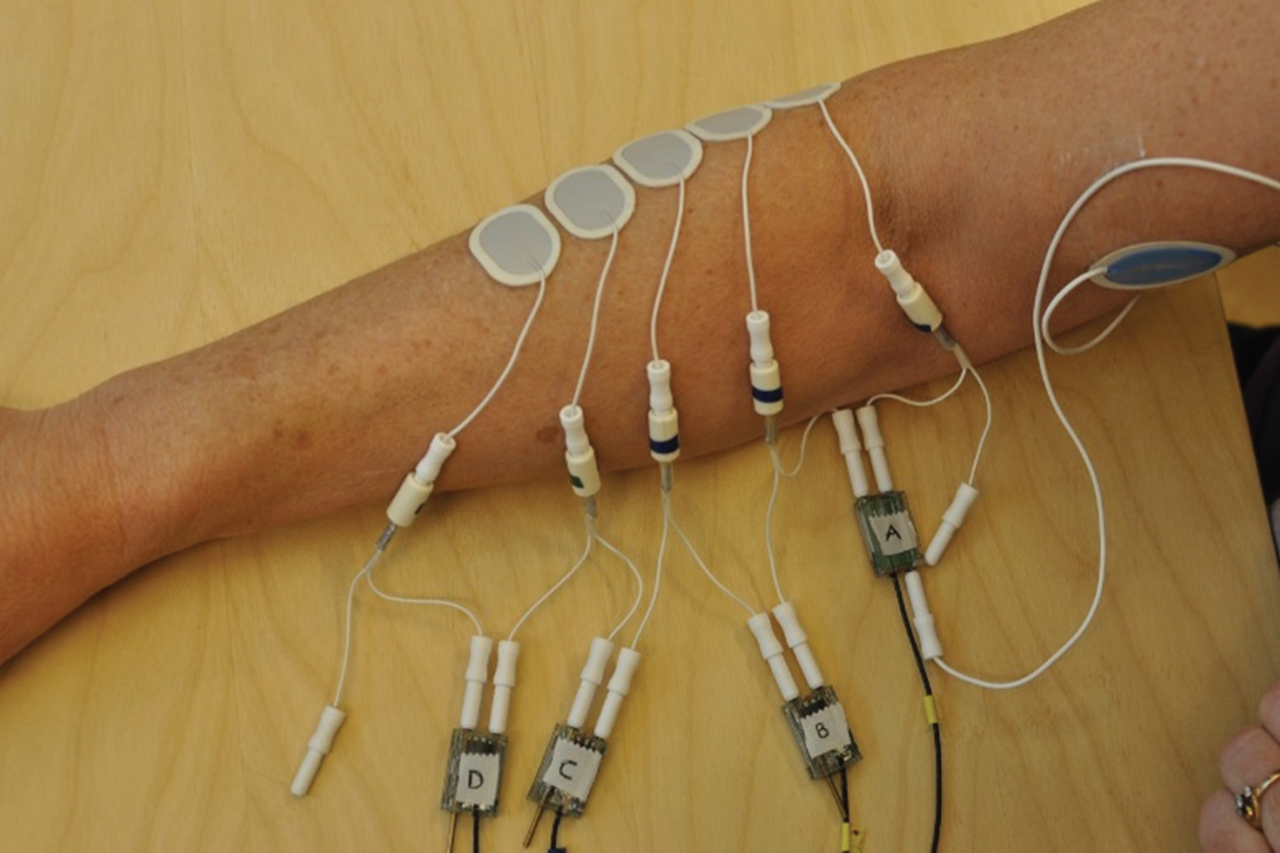 Electrode positioning on the right forearm extensor muscles. The electrodes are numbered 1 to 5 starting at the elbow. The large blue electrode is the ground electrode. The signals were measured between pairs of electrodes (A-D).