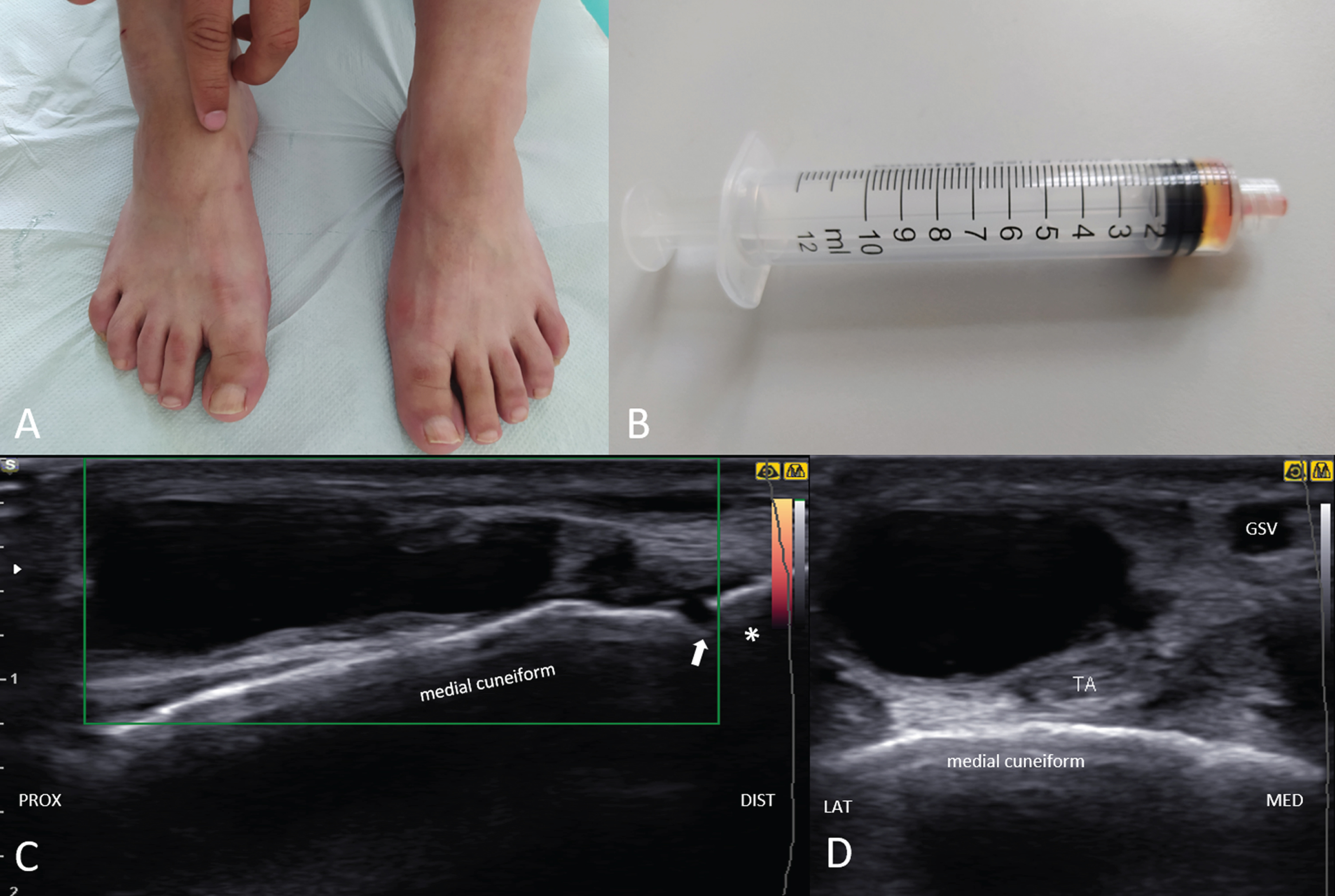 The physician’s finger indicates a mass on the patient’s right foot (dorsomedial aspect) (A). The syringe contains 1 mL of gelatinous and yellowish fluid aspirated from the ganglion (B). Ultrasonography (long-axis view) shows an irregular, septated, and hypoechoic mass in continuity with the 1st metatarsal-cuneiform joint with no hypervascularisation under power Doppler imaging (C). Adjacent tibialis anterior tendon (TA) is seen in the short axis-view (D). Asterisk; 1st metatarsal bone; arrow; 1st metatarsal-cuneiform joint, GSV; greater saphenous vein.