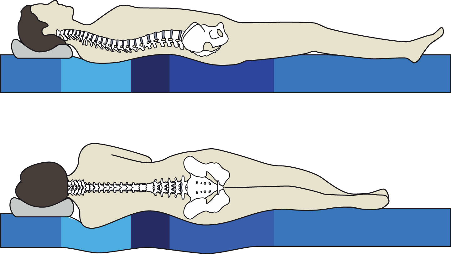 Example of supine and lateral support for a ‘straight’ back. From Smulders [2].