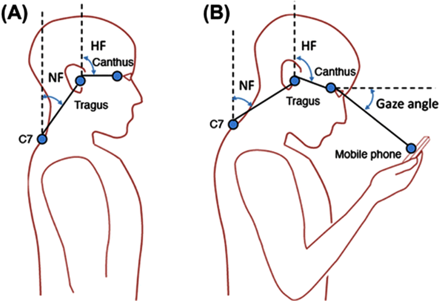 Visual depiction of the head flexion angle (HF) and neck flexion angle (NF) both in neutral head posture and during HHMD use.