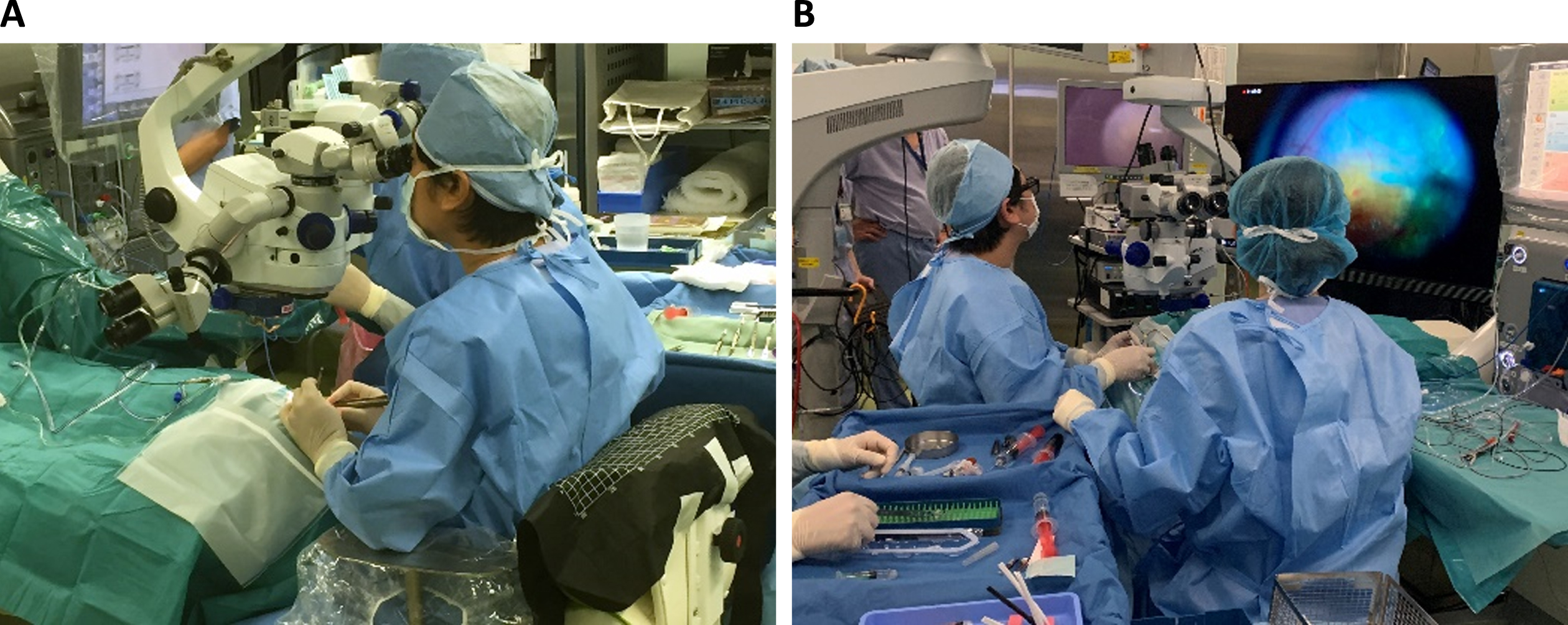 (A) Image showing surgery using the conventional ophthalmic microscope. (B) Image showing surgery performed through a heads-up display system.