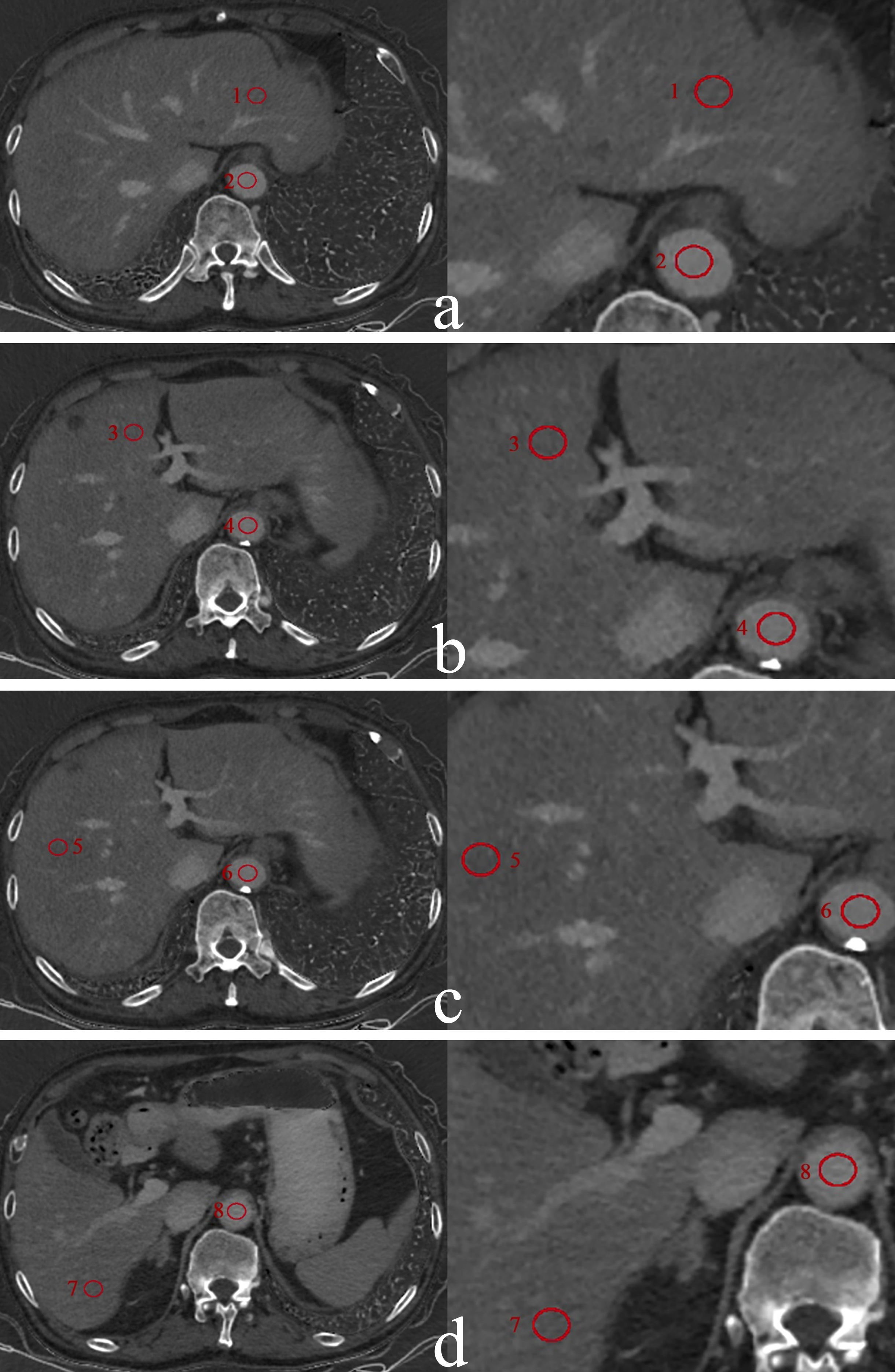 The measurement of ECVliver in a 75-year-old man with primary hypertension in Grade 1 hypertension group. Liver iodine maps (iodine-water basic pair) were generated from spectral CT in equilibrium phase at the level of the left lateral lobe of the liver (a), the left medial lobe (b), the right anterior lobe (c) and the right posterior lobe (d). Eight red circles represent the ROIs placed in the left lateral lobe (1), the left medial lobe (3), the right anterior lobe tail (5), the right posterior lobe (7) and abdominal aorta (2, 4, 6, 8) at the same level, respectively.