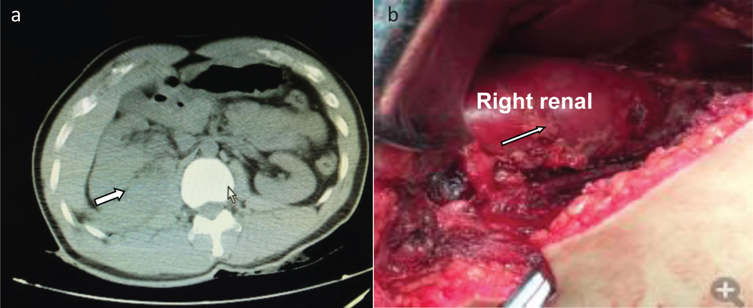 (a) Right kidney enlarges due to injury. (b) Surgical exploration showed a complete right kidney (Lunbarartery hemorrhage).
