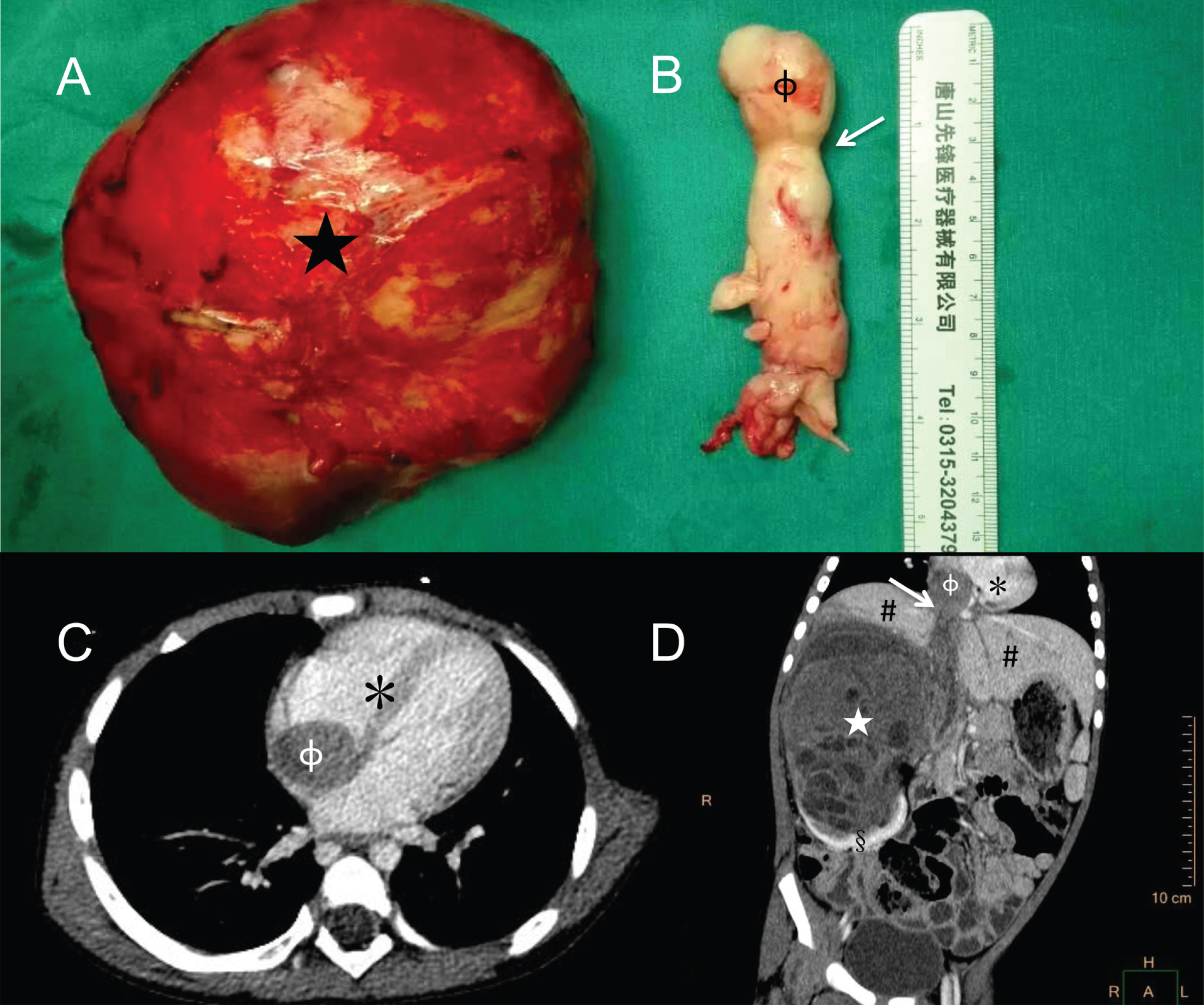 Surgical samples and CT images of Wilm’s tumor, intravenous and right atrium embolus. Surgical samples of the renal mass in right kidney (A), and embolus from the right aterium (B). CT image of the renal mass and embolus: cross section (C) and coronal (D) (★: Wilm’s tumor in right kidney; Φ: embolus in right atrium; *: heart; #: liver; §: residual kidney; Arrow: press mark of diaphragm surround the embolus).
