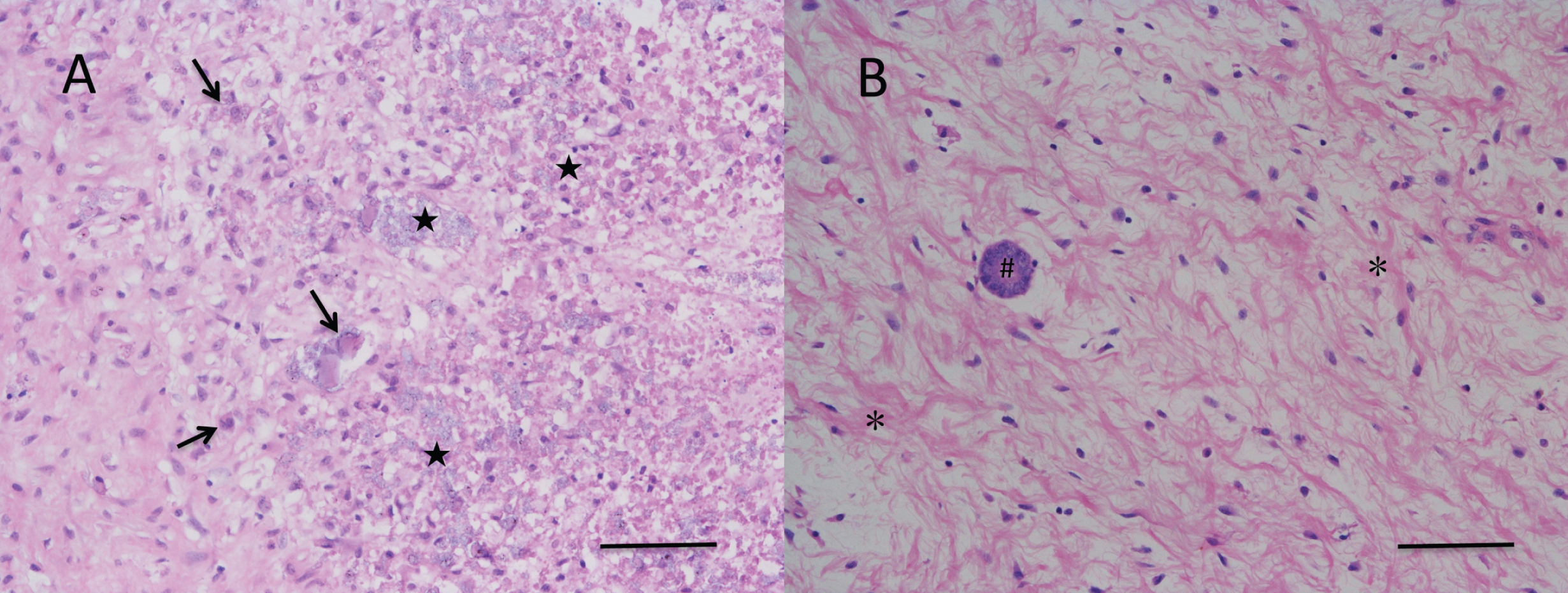Histopathology of the tumor in right kidney, intravenous and right atrium embolus. (A), Patchy necrosis (★) and atypical tumor cells (arrow) were observed in intravenous and right atrium tumor embolus; (B) Kidney tubules (#), hyperplasia of spindle cell (*) but no anaplasia was found in kidney post-chemotherapy. (HE stain, bar = 100 μm).
