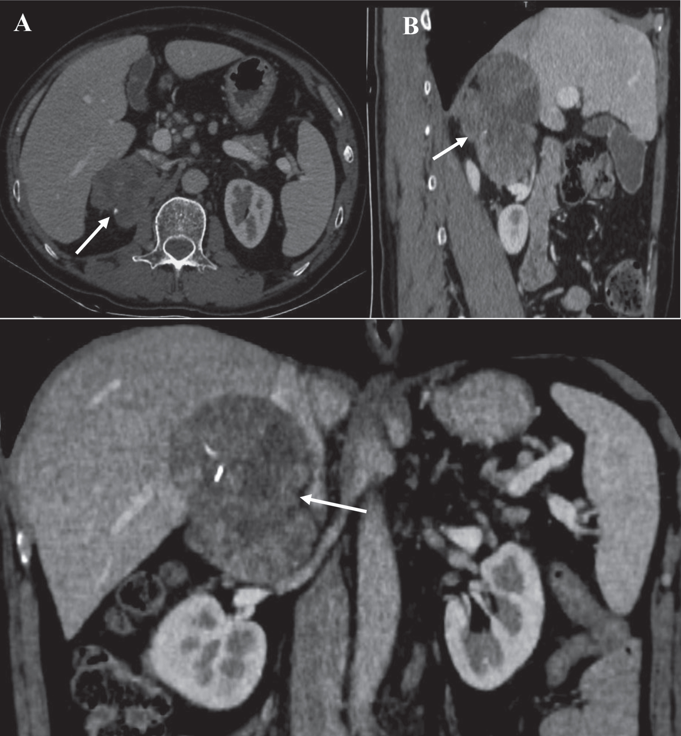 A larger tumor in right adrenal gland. Enhanced CT images submitted to doctor in regular pattern. (A) axial plane; (B) sagittal plane; (C) coronal plane. Arrow: ACC.