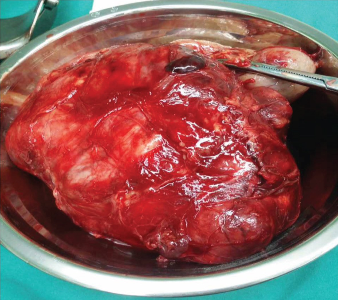 Gross view of completely-resected adrenal carcinoma. The tumor was entirely covered by the capsular and minimal tissue adhesion and the tumor size was 6.8 cm ×5.2 cm.
