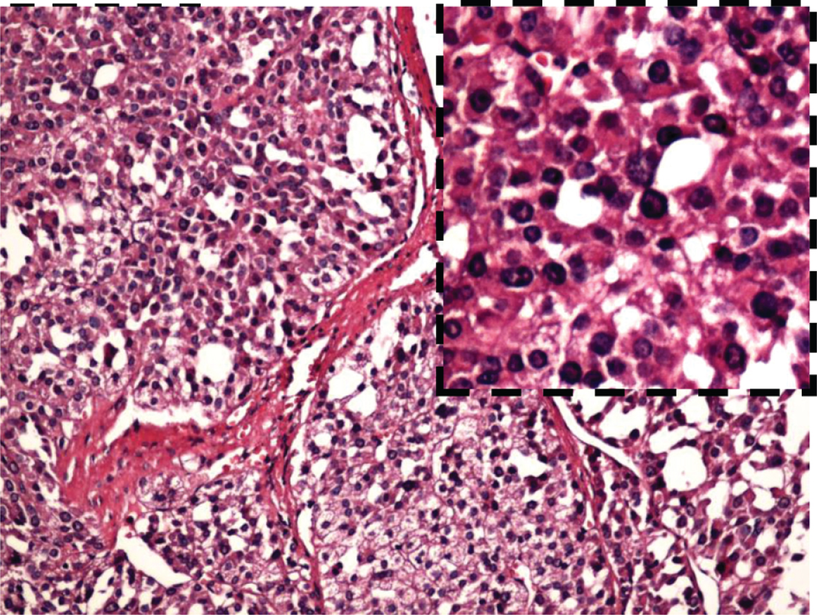 The pathological result of the large adrenal gland tumor. The carcinoma is mainly constituted by eosinophils in adrenal cortex. The carcinoma cells are separated by wide fibrous band, accompanied by calcification and necrosis. (H.E. staining) ×40.