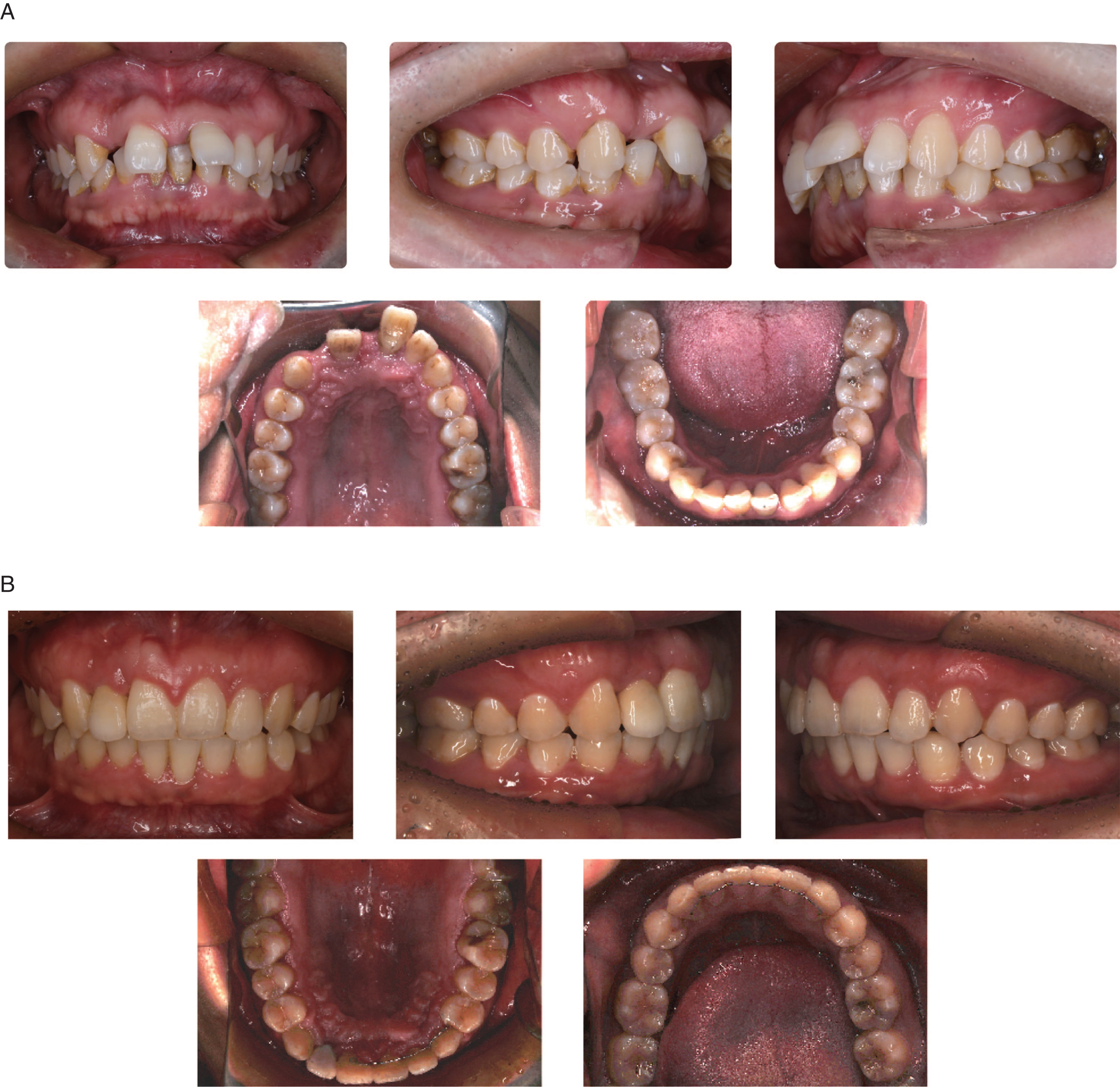 Comparision of intraoral potographs of pre- and post-treatment. A. Intraoral photographs of pre-treatment; B. Intraoral photographs of post-treatment.