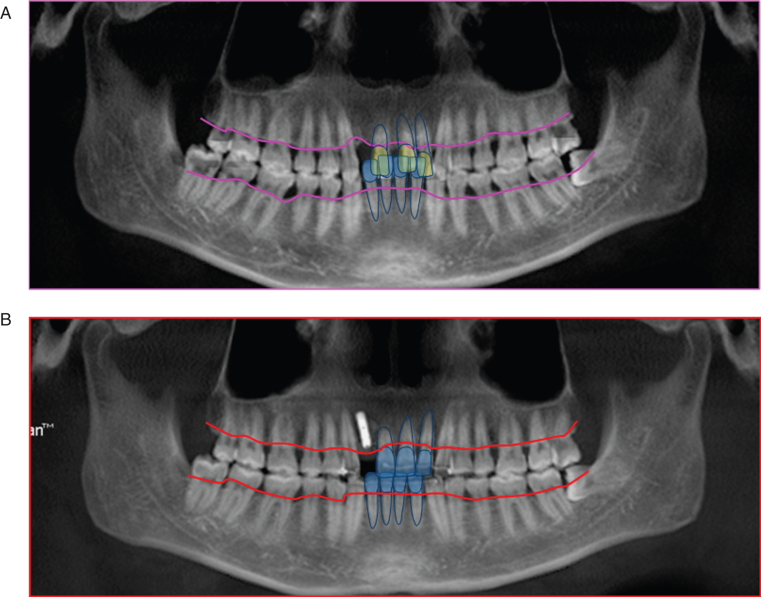 Panoramic radiograph of pre- and post-treatment. A. Panoramic radiograph of pre-treatment; B. Panoramic radiograph of post-treatment. The images showed the relationship between the absorption lines of alveolar bone and the anterior teeth of the uper and lower jaw. The height of alveolar bone in the anterior region was significantly increased.