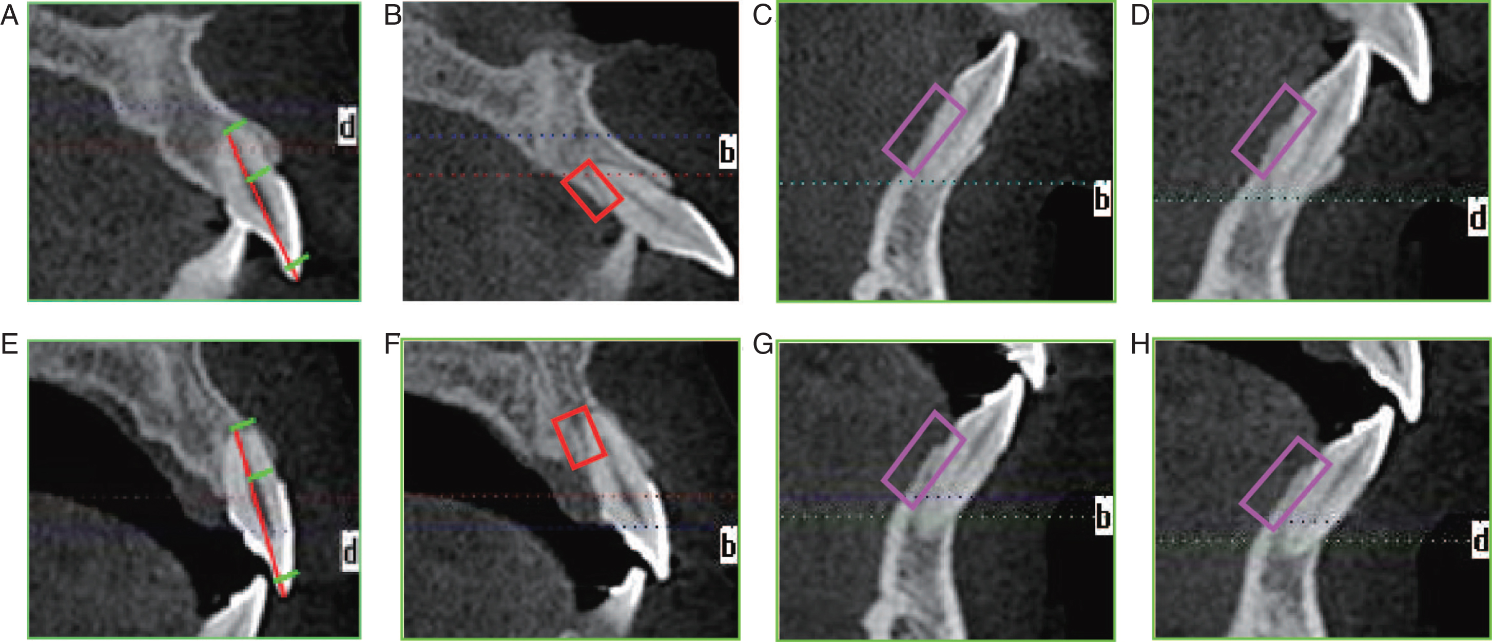 Changes of the anterior region of the maxillary and mandibular teeth. A,B,C,D: static CBCT images of the maxillary right central incisor, maxillary left central incisor, mandibular right central incisor, mandibular left central incisor before treatment; E,F,G,H: static CBCT images of the maxillary right central incisor, maxillary left central incisor, mandibular right central incisor, mandibular left central incisor after treatment; These images showed that no further root absorption was seen in the maxillary right central incisor when the treatment was finished, and the lingual alveolar bone height and thickness was obviously increased in maxillary left central incisor, mandibular right central incisor and mandibular left central incisor.