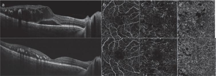 SD-OCT (a) and OCTA (b-d) images of a patient with diabetic macular edema before (top) and after (bottom) intravitreal dexamethasone implant [18]. (Used under the terms of the Creative Commons Attribution 4.0 license)