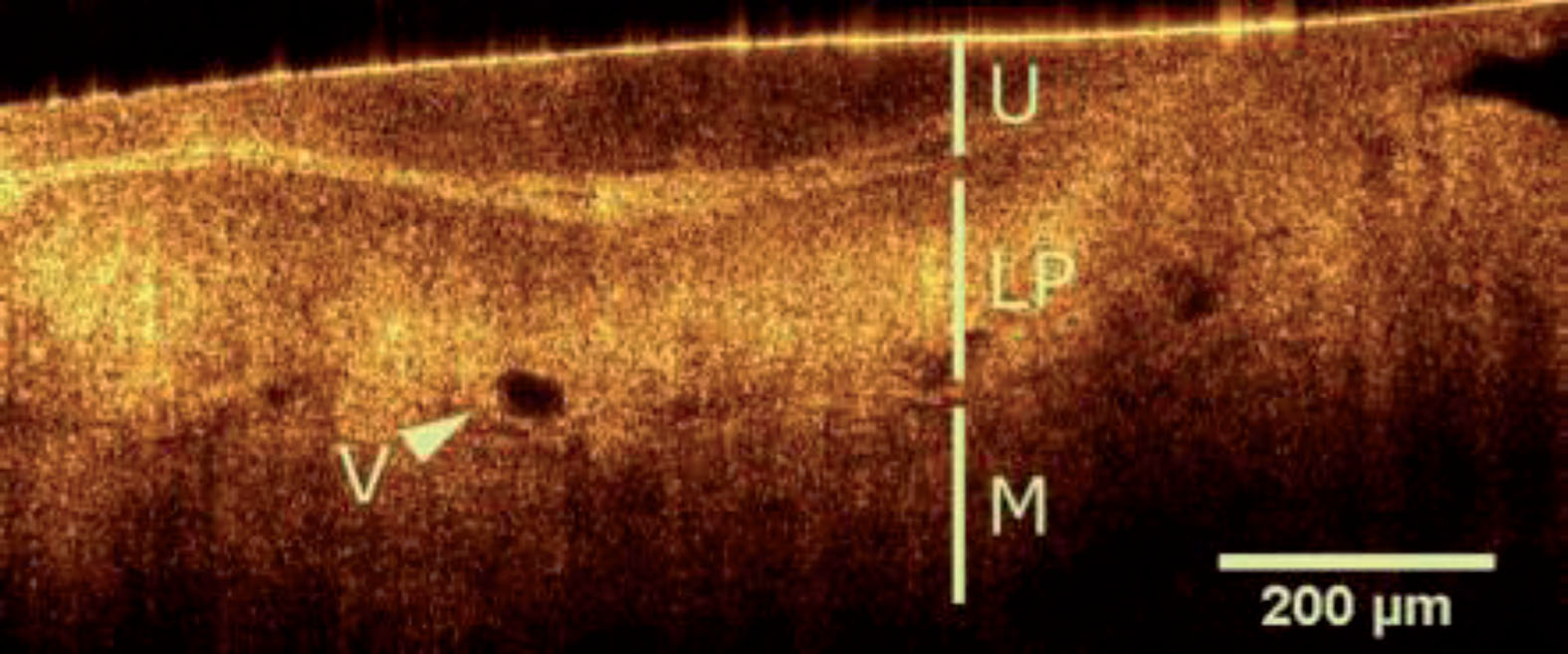OCT image of a healthy bladder wall indicating urothelium (U), intact lamina propria (LP) and muscularis (M) [56]. (Used under the terms of the Creative Commons Attribution 4.0 license)