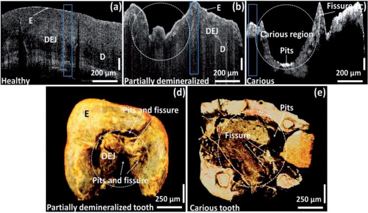 The OCT images of healthy, partially demineralized, and completely demineralized (carious) molar tooth samples [51]. (Used under the terms of the Creative Commons Attribution 4.0 license)