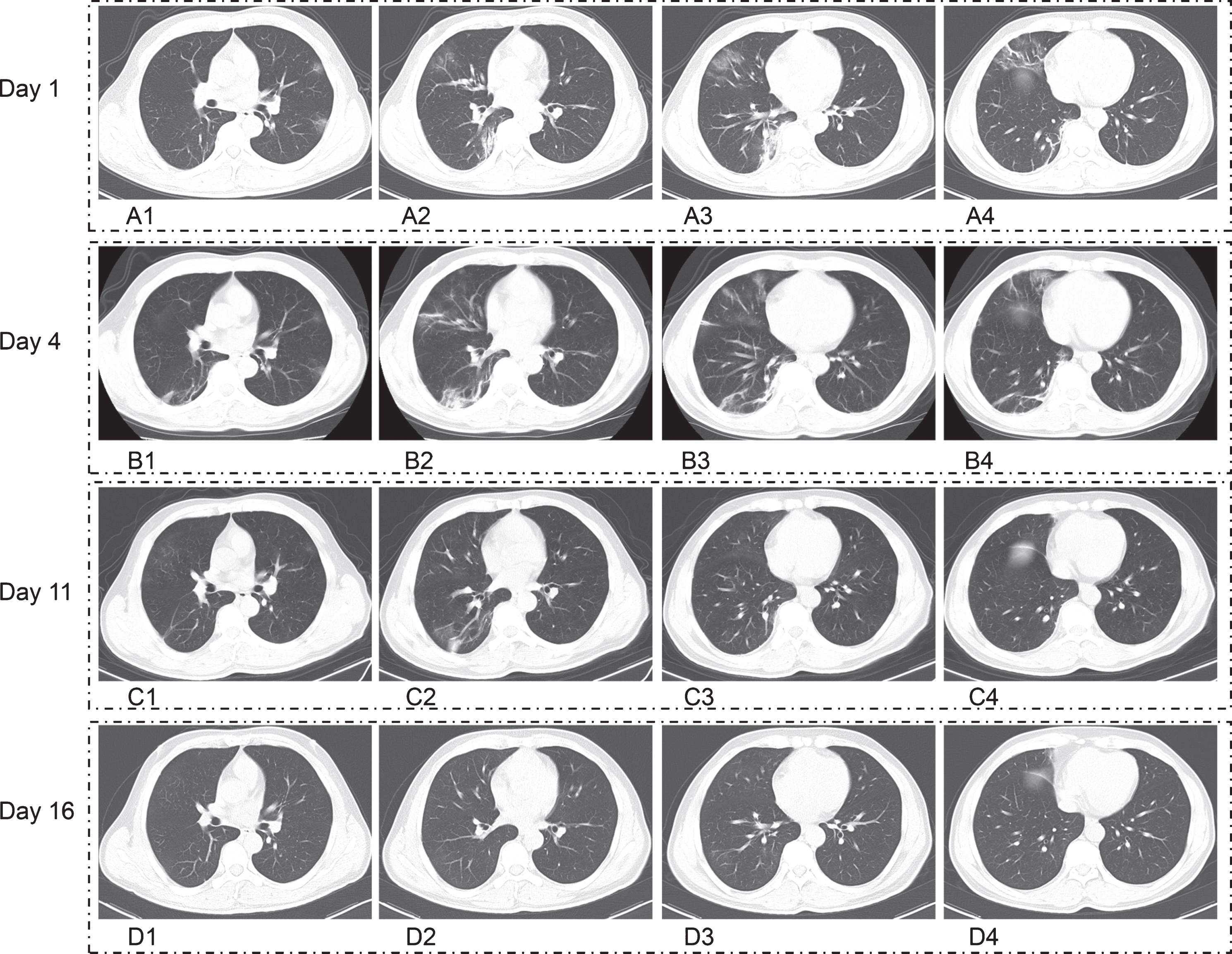 Fifty-one years old man with COVID-19 pneumonia who had the history of exposure for recent travel to Wuhan, with body soreness, headache for 7 days. A1–A4. Axial computed tomographic (CT) images first time revealed that the lesions were involvement of both lung with the CT characteristics of GGO, consolidation, bronchovascular enlarged, irregular linear appearances, and most of lesions distributed peripherally, there were no the CT features of pleural effusion. B1–B4. Following up CT images on day 4 shown that lesion had been progress. C1–C4. Following up CT images on day 11 demonstrated that most of lesions had been absorption after treatment. D1–D4. Following up CT images on day 16 manifested that all of lesions had been absorption.