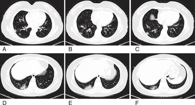 Fifty-three years old woman with COVID-19 pneumonia who had the history of exposure for recent travel to Wuhan, with cough for 2 days. A–F. Axial CT images shown that the ill-defined margin GGO mixed consolidation observed in right lower lobe significantly.