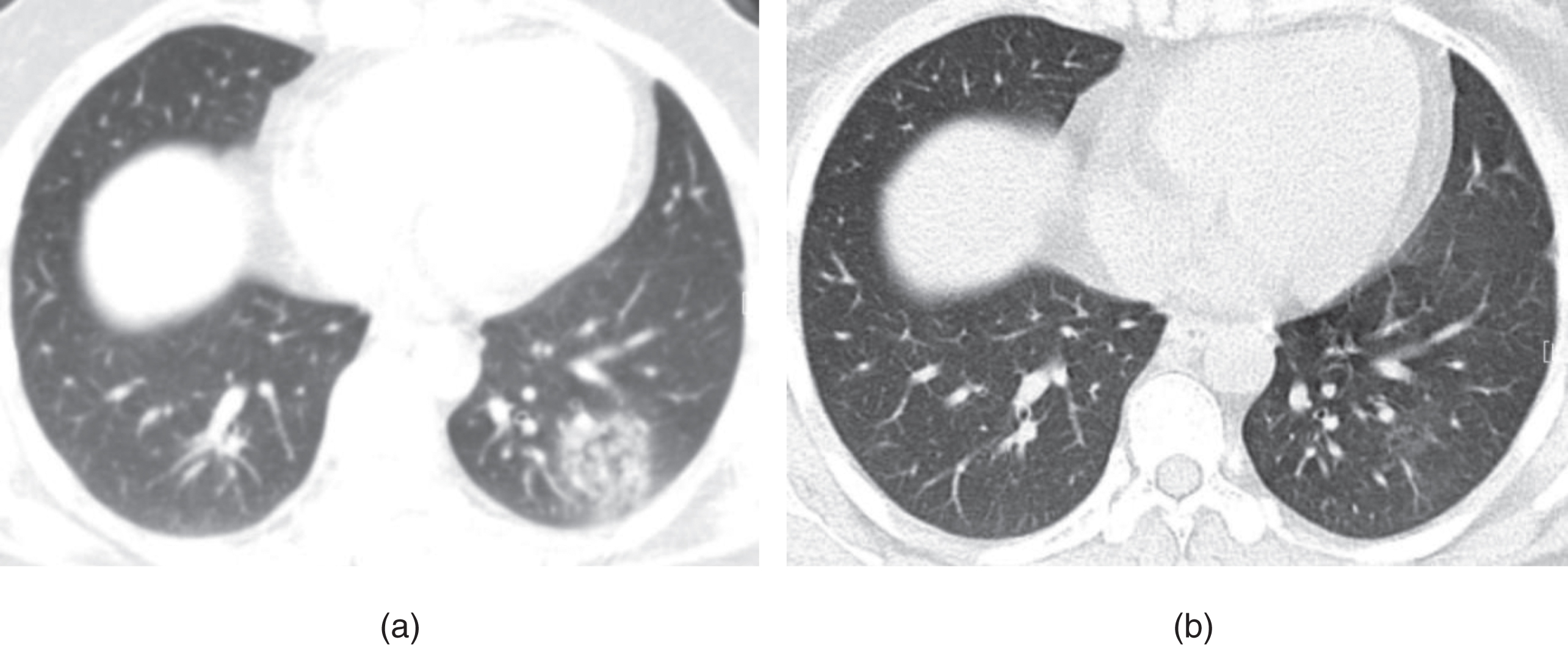 Example of CT image slices of a male COVID-19 patient of 32 years old. (a) CT scan performed 5 days after admission. Images show a focal ground-glass opacity in the lower lobe of the left lung. (b) Follow-up CT taken after discharge (or obtained on day 27 after admission to hospital). The lesion was basically absorbed, leaving a little GGO. This patient was enrolled in group B.
