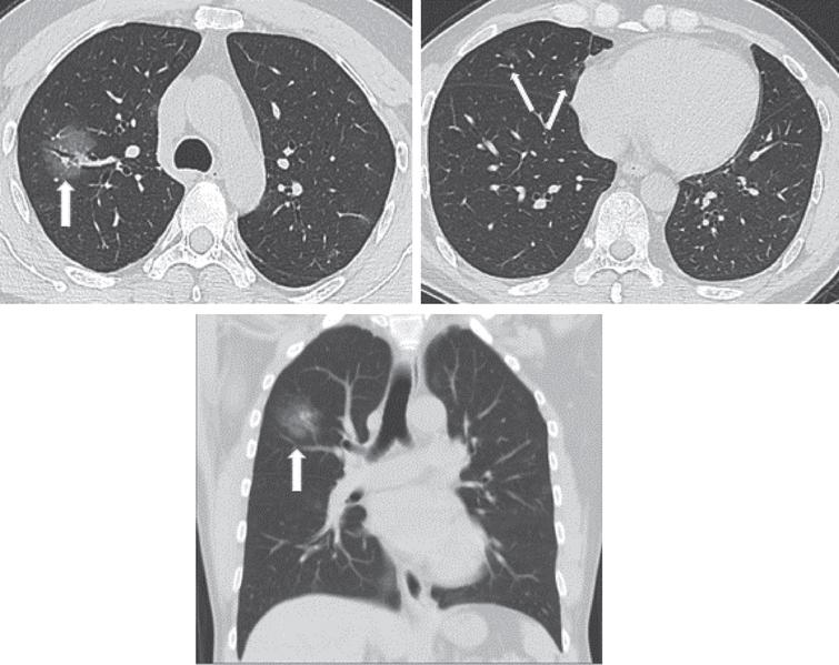 Example images show a 52-year male patient who had onset of fever up to 39.1° on January 26th, 2020, complicated with fatigue and dry cough with a positive nucleic acid test. He underwent the first CT scan on January 27th, 2020, day 2 after the onset, which showed in the upper right lung a patchy GGO containing thickened blood vessels and air bronchogram. Small patches of GGOs are scattered in the middle lobe of the right lung.