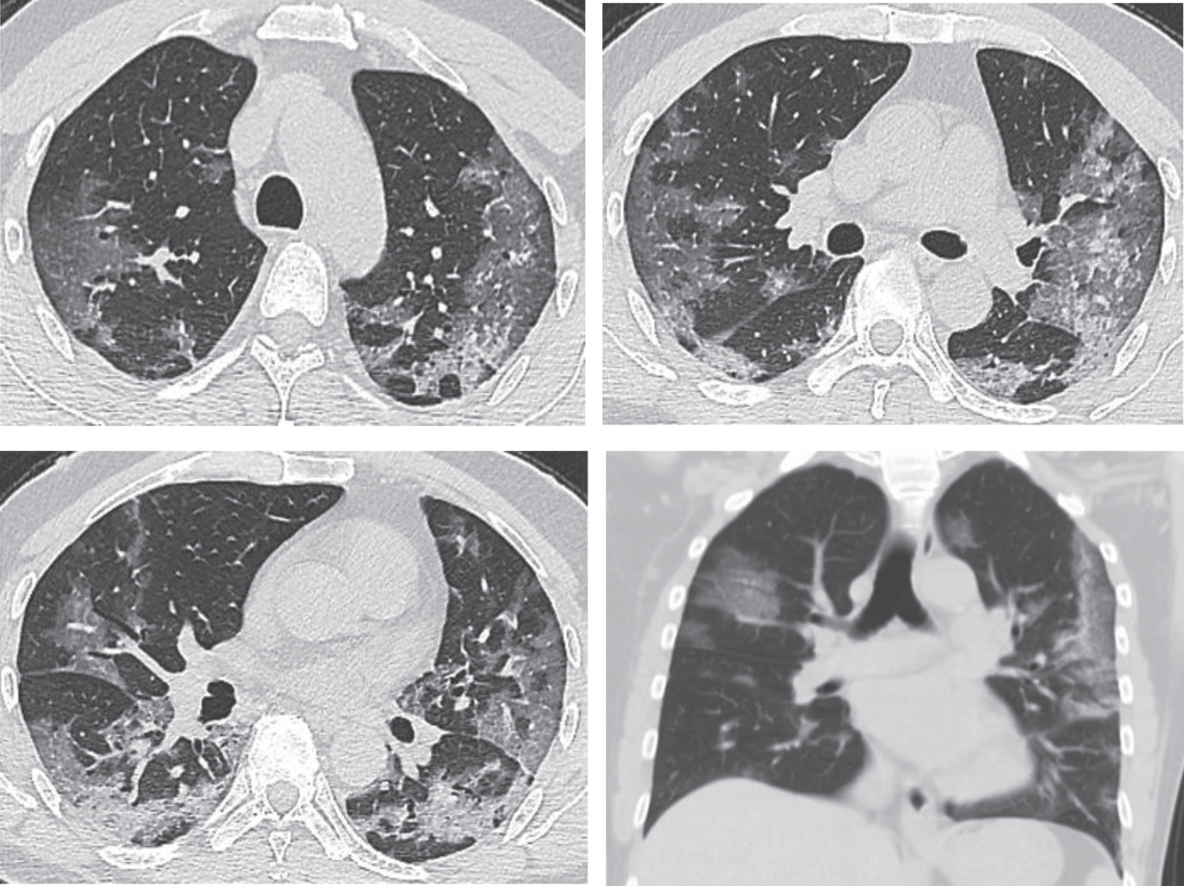 Images of the same patient as shown by Fig. 1, which manifest an obviously increased number of lesions with progression in both lungs in CT scans on February 3rd, 2020, day 9 after the onset. Multiple large patchy GGOs appear in both lungs with consolidations containing air bronchogram inside and obvious thickening of interlobular septum.