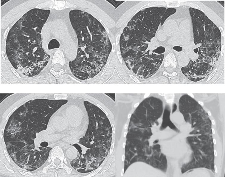 Images of the same patient as shown by Figs. 1 and 2. CT scans on February 21st, 2020, day 24 after onset (during the absorption stage), show a gradual decrease and absorption of large patches of GGOs in both lungs, which are scattered with cord-like, reticulate and patchy opacities, with obvious thickening of interlobular septum.