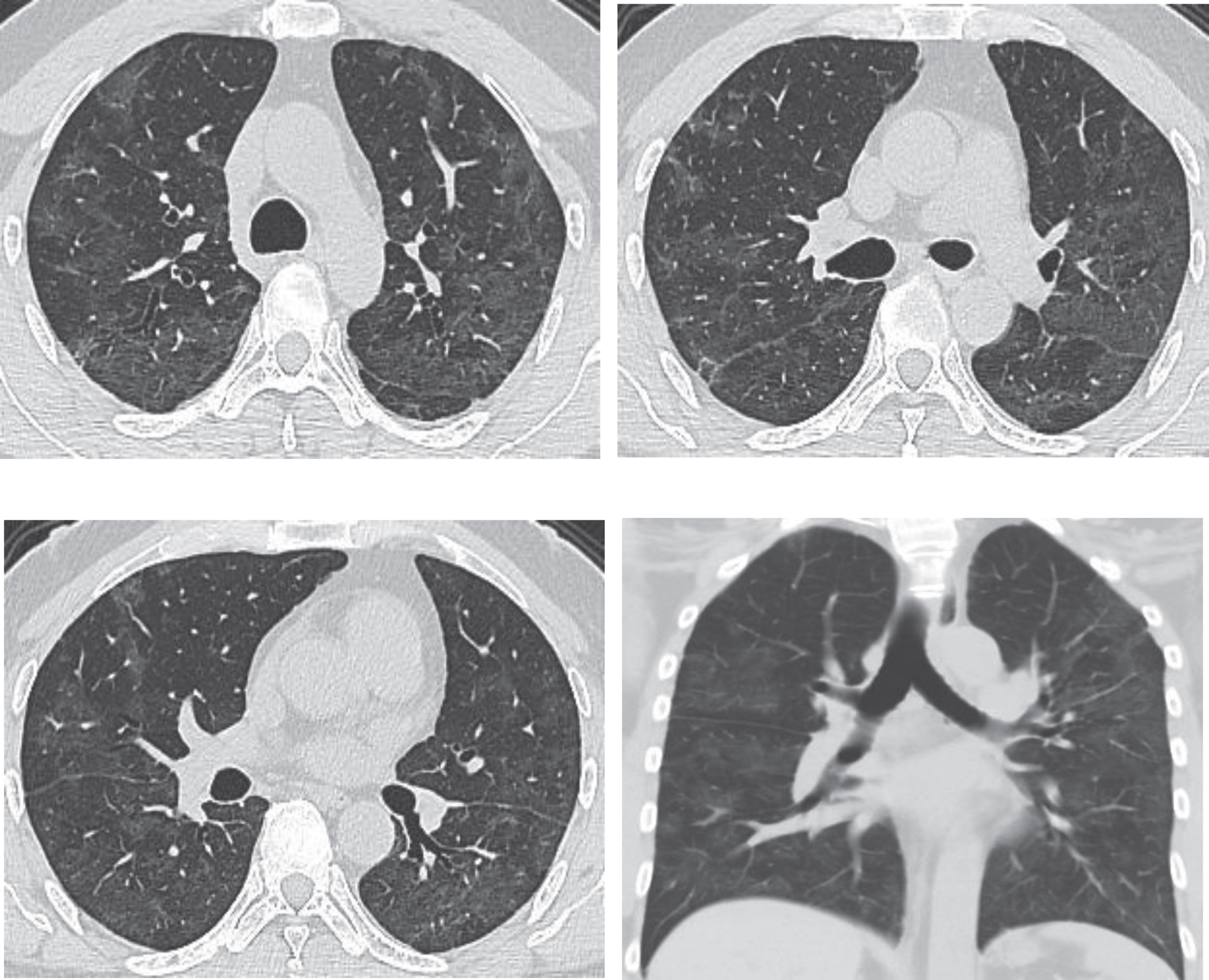 Chest CT scans on March 20th, 2020, for the same patient shown by Figs. 1–3, after treatment, showing obvious absorption of lesions (decreased lesions with partial fibrosis). After admission, the patient received antiviral and atomizing therapies, but symptoms aggravated with repeated fever, cough, expectoration, and gasp. A written notice of danger was given on February 2nd 2020, and the patient was given oxygen inhalation, continuous ECG monitoring, finger pulse oxygen monitoring, anti-infection treatment, anti-virus therapy, atomization of recombinant human interferon α2b and intravenous injection of human immunoglobulin to improve immunity, as well as symptomatic treatments to reduce inflammation. The symptoms improved after treatment. Chest CT scans on March 20th showed the obvious absorption of the lesions. Re-test of nucleic acid of novel coronavirus after an interval of 24 hours was negative. The patient was discharged in agreement after consulting with the Municipal Novel Coronavirus Pneumonia Expert Group of the 4th People’s Hospital of Nanning City.