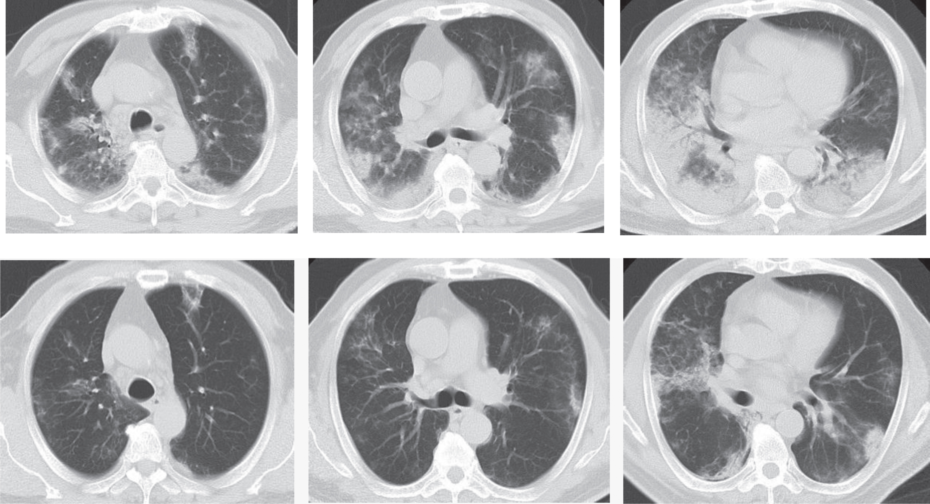 Example CT images of a 63-year-old male patient diagnosed with H7N9 avian pneumonia. Top row shows chest CT scans taken on January 17th, 2014, day 11 after the onset, in the progression phase. CT scans show patches of ground glass opacities in the upper right lung and the upper left lung, dominantly distributed in the subpleural zone. Consolidations can be seen in the lower lobes of both lungs, with air bronchogram inside dominantly at the lower right lung. Bottom row shows chest CT taken on January 24th, 2014, day 18 after the onset during the absorption period. CT shows the obvious absorption of ground glass opacities and consolidations in both lungs, which have been dominantly interstitial changes and small patches of consolidations.