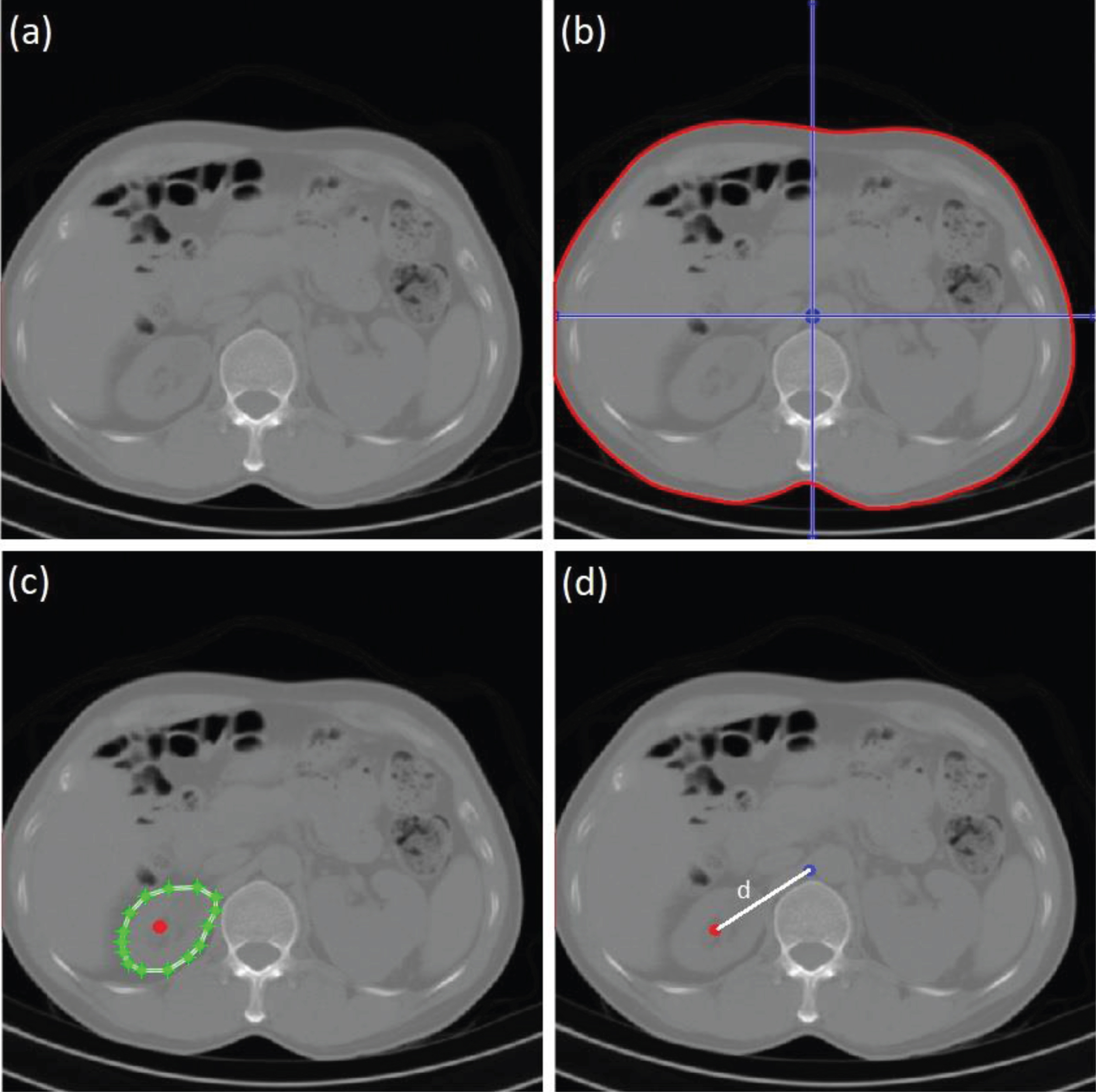 Example images of organ (left kidney) dose estimation. (a) image of abdomen, (b) water-equivalent diameter and patient centre determination, (c) volume and organ centre determination, and (d) distance between centre of patient and centre of organ computation.