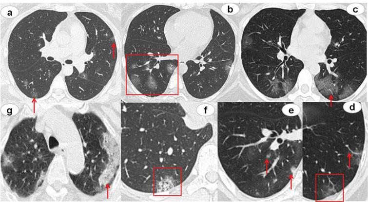 CT findings of COVID-19 pneumonia. The red arrows and boxes indicated the abnormalities. Multifocal GGO was showed in both lungs, subpleural distribution (a) or the mixed distribution (b). Concomitant features included lesion with dilatation of vessels (c, d), Interlobular septal thickening (c), and lesion adjacent pleural thickening (d). The rare CT features were nodules (e), honeycomb pattern (f), and focal consolidation (g).