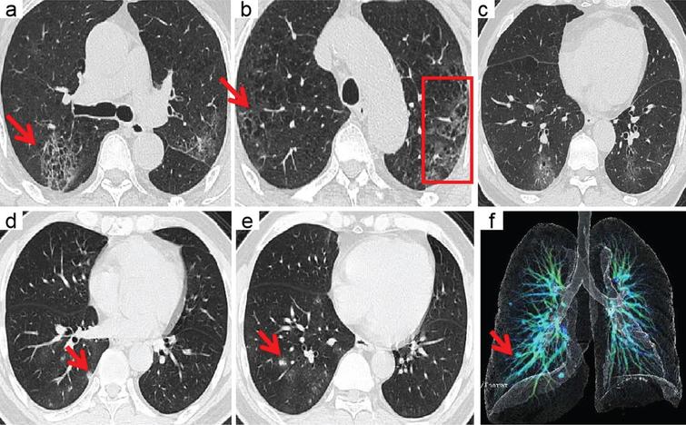 A 70-year-old man with confirmed COVID-19, Patient had short-term exposure history to Wuhan and onset symptoms of fever (38.5°C) and cough. CT images show bilateral mixed distributions of ground-glass opacities (GGO). The concomitant abnormalities included honeycomb pattern (red arrows) and interlobular thickening (boxes). CT involvement score is 11 (a– c). A 46-year-old man with confirmed COVID-19, Patient had short-term exposure history to Wuhan and onset symptoms of fever (37.3°C) and cough. CT images show lung right lobe multi ground-glass opacities (GGO) and nodules (red arrows). CT involvement score is 3 (d– f).