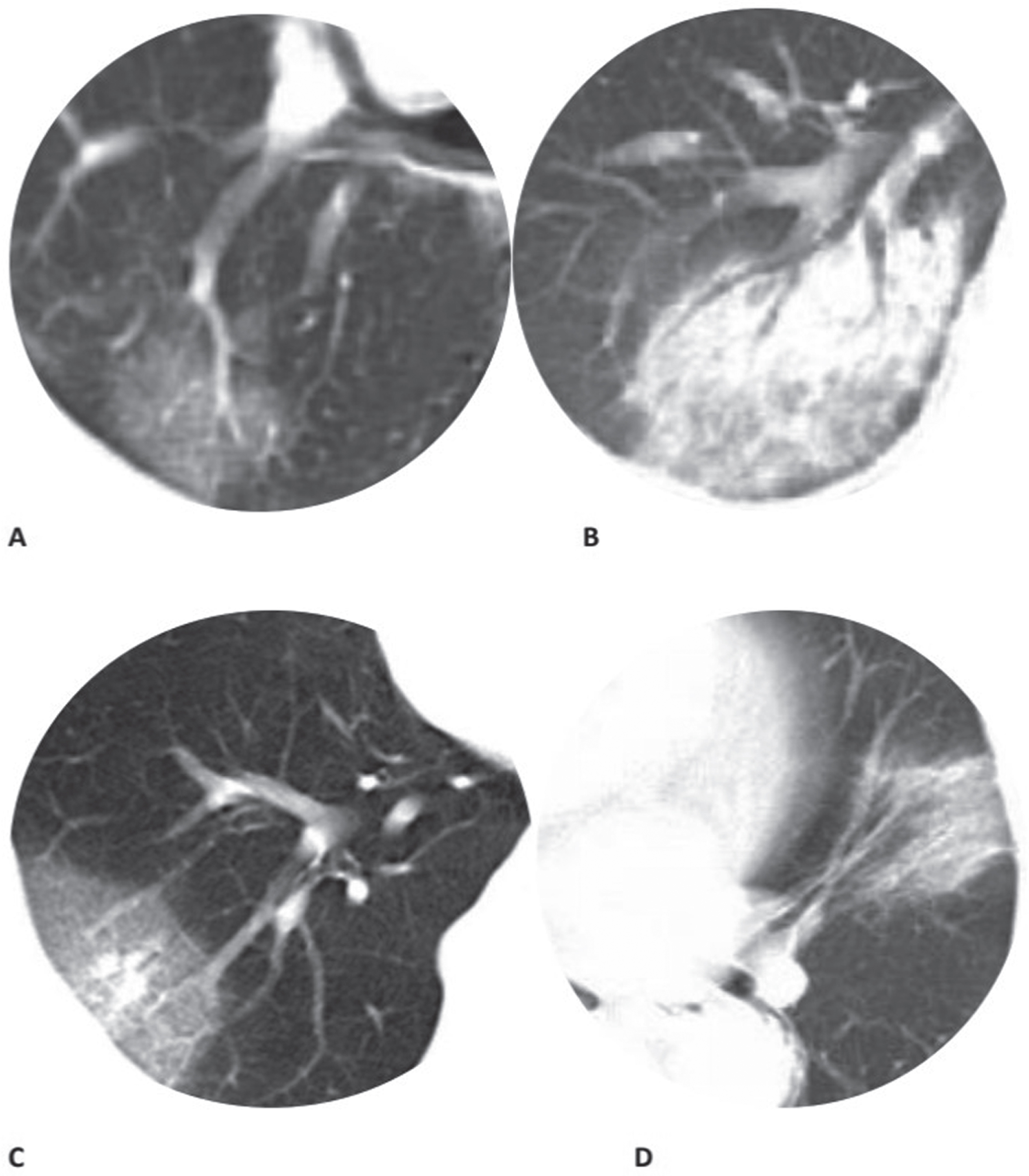Chest CT findings of moderate COVID-19 pneumonia on axial images (a) GGO; (b) Consolidation; (c) Vascular thickening; (d) Bronchial wall thickening. The same window level and width were set on all images.