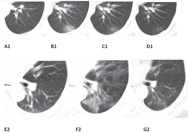 Typical evolution of CT findings (A1, B1, C1, D1 correspond to the same case). Typical evolution of CT findings in a 45-year-old male presenting with persistent fever (38.0°C) for two days. (A1) At presentation (day 3), there were no abnormalities on chest CT; (B1) day 7, There was a small subpleural GGO with partial consolidation in the lower left lobe; (C1) day 12, partial resolution of the initial GGO and consolidation; (D1) day 16, continued absorption with minimal residual lesions and parenchymal bands were observed. (E2, F2, G2 correspond to the same case) Typical evolution of CT findings in a 46-year-old male presenting with persistent fever (38.0°C) for four days. Bronchial wall thickening can be observed from day 4 to day 8, and its recovery can be observed on day 13. The same window level and width were set on all images.