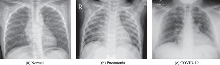 An example of Normal, Pneumonia, and COVID-19 CXR images.