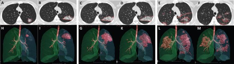 The dynamic lung changes in a 38-year-old female COVID-19 patient. Images (from A to M) were obtained from a 38-year-old female COVID-19 patient. The chest CT images of day 1 (A, H), day 3 (B, I), day 5 (C, G), day 7 (D, K), day 12 (E, L) and day 28 (F, M) showed the dynamic changes of the lesions. The lesion volume reached the highest on day 12 (8.18 ml, 32.99 ml, 77.05 ml, 110.95 ml, 174.67 ml, 112.48 ml, respectively), and the lesion density reached the highest on day 5 (– 491.15HU, – 361.79HU, – 320.23HU, – 406.33HU, – 437.28HU, – 594.02HU, respectively). The standardized mass reached the highest on day 12 (0.0634, 0.1884, 0.3896, 0.7119, 1.2061, and 1.0550, respectively). This trend was consistent with that of the radiologists’ interpretation.
