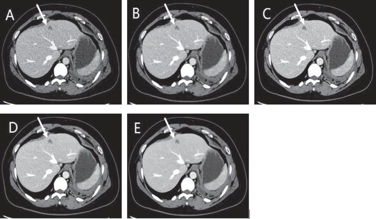 A 55-year-old female with liver cysts (arrows) showed on d ASIR-V 30 (AV-30) (A), ASIR-V 70 (AV-70) (B), DLIR-low (DL-L) (C), DLIR-medium (DL-M) (D), DLIR-high (DL-H) (E). As the strength of DLIR increased, image noise was gradually reduced, but not that of the other parameters. DL-M and DL-H provided better image quality than ASIR-V in term of overall score, which was mainly due to the lower image noise.