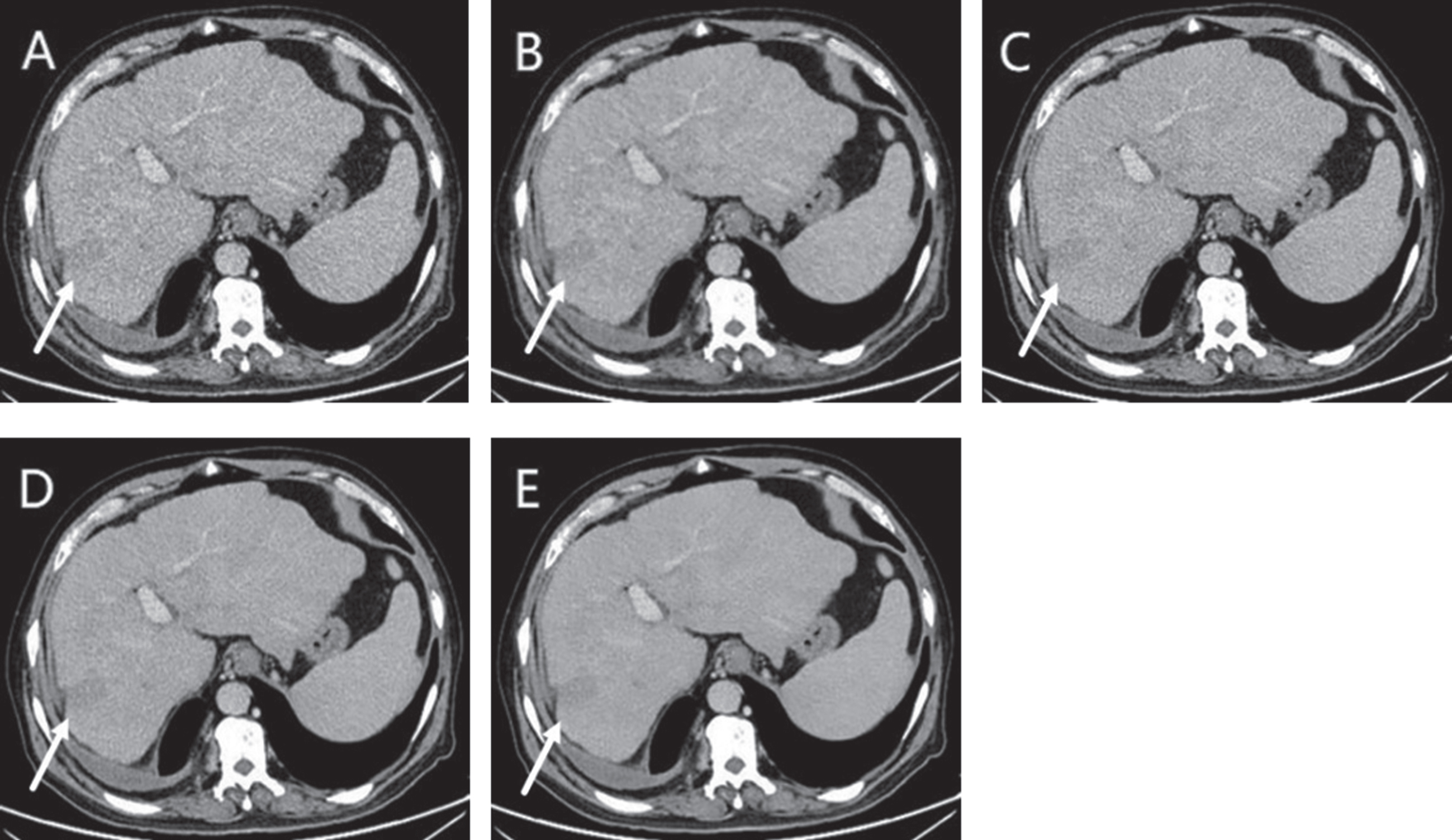A 65-year-old male with liver metastases with weakly enhancement (arrows) showed on ASIR-V 30 (AV-30) (A), ASIR-V 70 (AV-70) (B), DLIR-low (DL-L) (C), DLIR-medium (DL-M) (D), DLIR-high (DL-H) (E). DL-M and DL-H provided better visual image quality, which was mainly due to lower image noise. DL-M even had better lesion-clarity than DL-H because of the blurring observed in DLIR-high reconstructions.