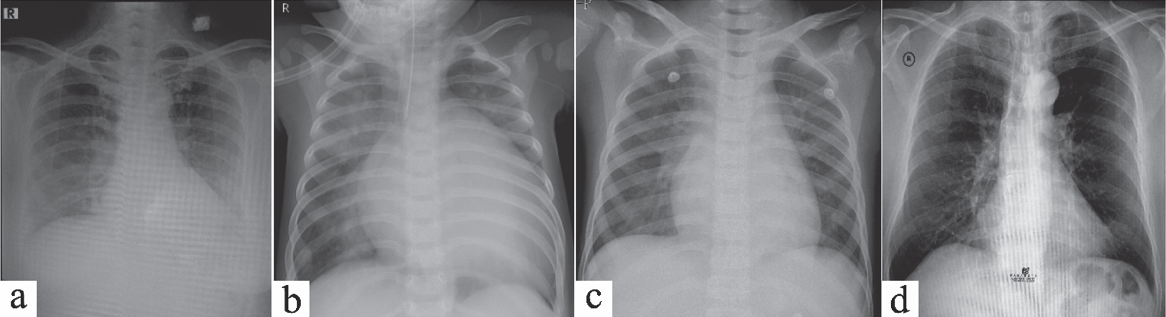 Chest X-ray image of: (a) Viral pneumonia and Positif COVID-19, (b) Bacterial pneumonia, (c) Viral pneumonia (negative COVID-19), and (d) Normal X-ray image.