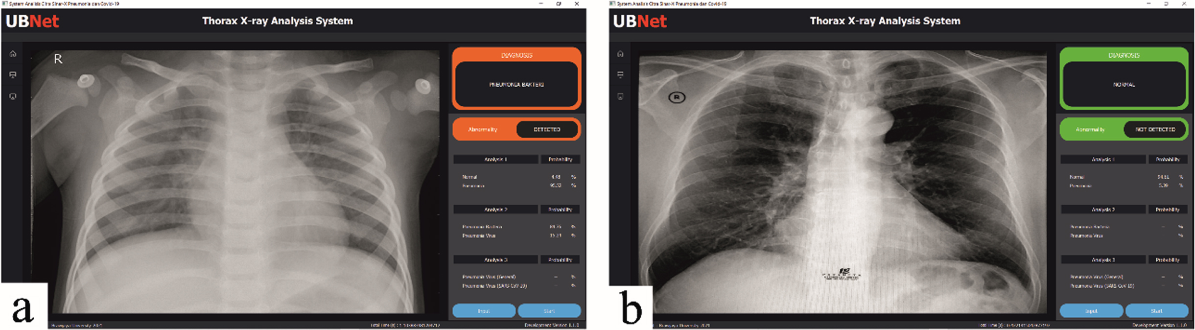 Trial of a GUI-based viewer system to analyze images of patients with (a) bacterial pneumonia and (b) normal.