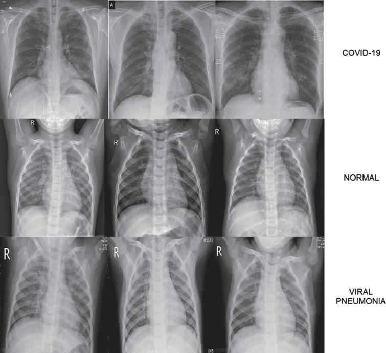 COVID-19, Normal and Viral Pneumonia Chest X-ray image samples found in dataset.