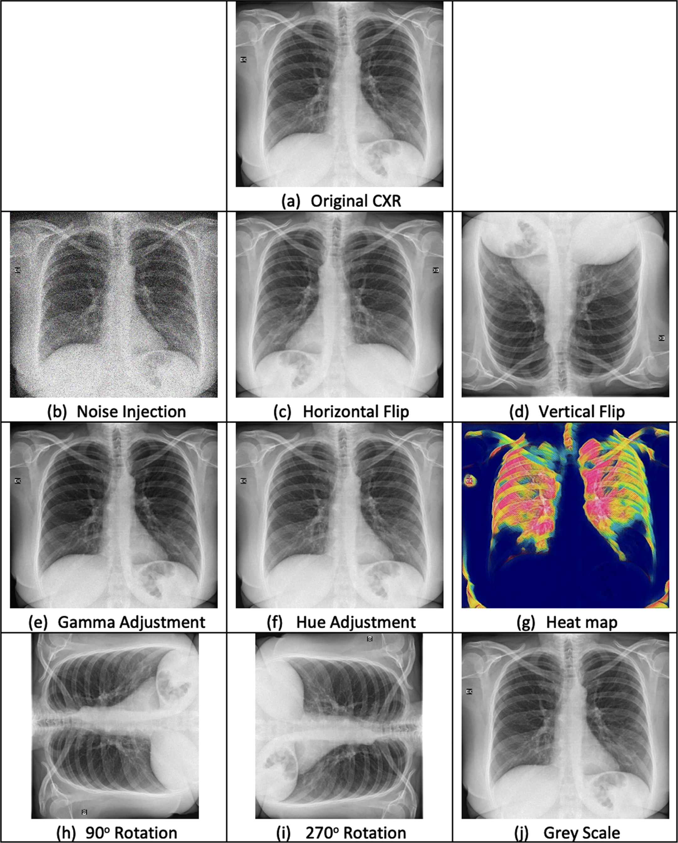 Effects of pre-processing and data augmentation on Chest X-Ray Images