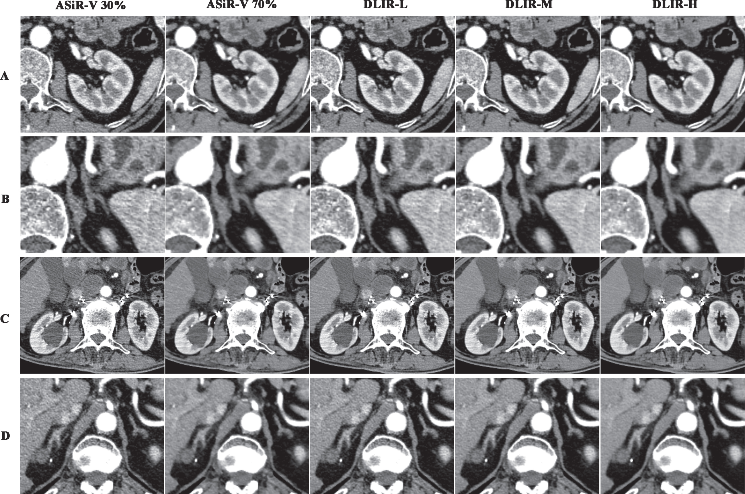Image quality comparison of ASiR-V 30%, ASiR-V 70%, DLIR-L, DLIR-M, and DLIR-H. Images were compared between all of the reconstruction datasets in contrast-enhanced renal and adrenal CT (A) (B). ASiR-V 70% showed similar subjective image appearances and objective values to DLIR-H and DLIR-M. However, DLIR images yielded better visual appearances even in some cases with high noise and artifact, as well as in some cases with small lesions. A case showed severe radial and stripy artifacts after the interventional therapy in adrenal glands. Additionally, several renal cysts showed. DLIR images showed a better denoise effect and depiction of lesions. (C). Another case showed a small and low-attenuation lesion in the right adrenal gland which was close to the hepatis. The boundary between them was better differentiated in DLIR images (D).