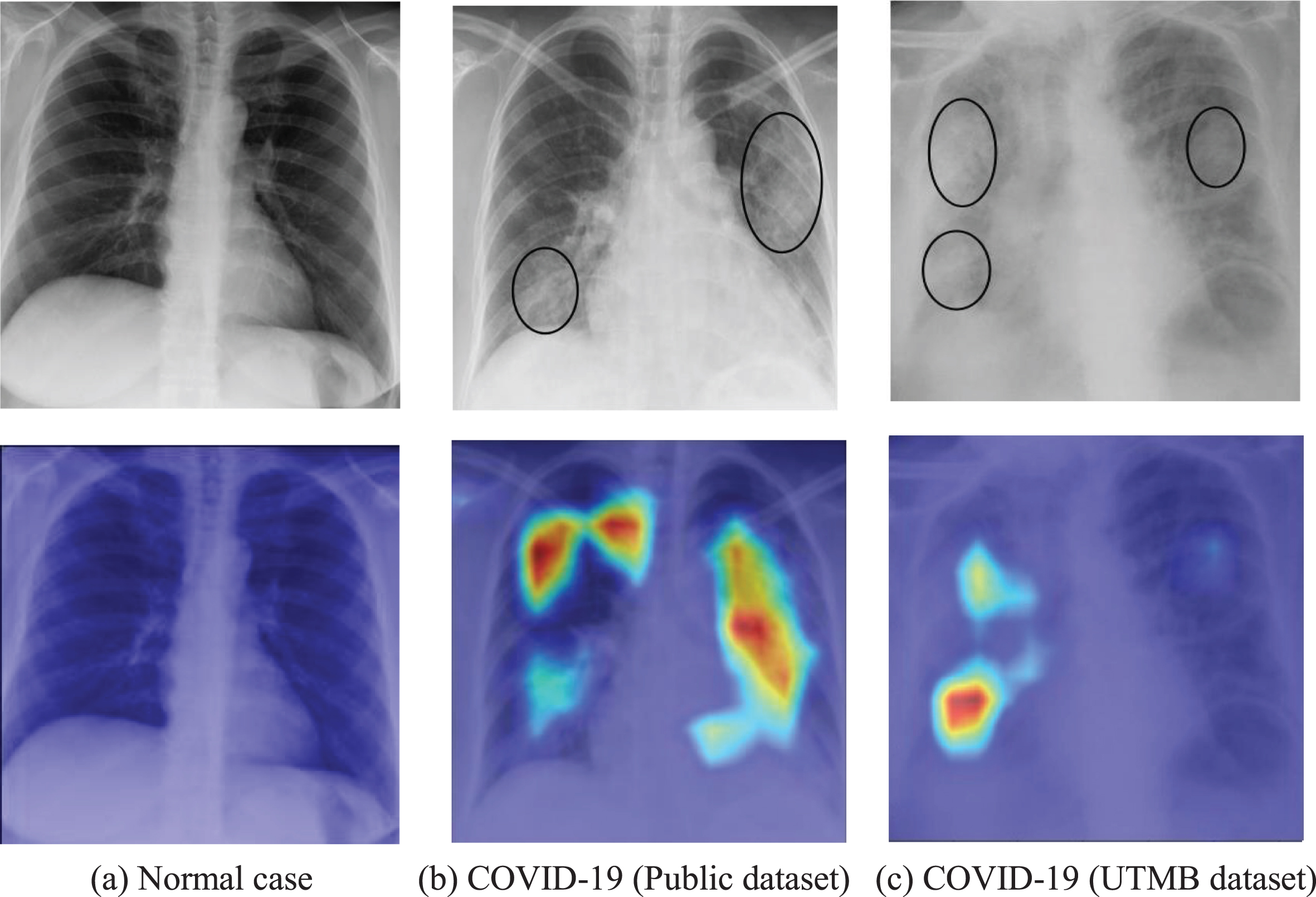 Examples of probabilistic Grad-CAM of COVID-19 class. The first row is the original X-ray image and the second row is corresponding visualization map, where the COVID-19 infection areas were marked (using ellipses) by an experienced radiologist.