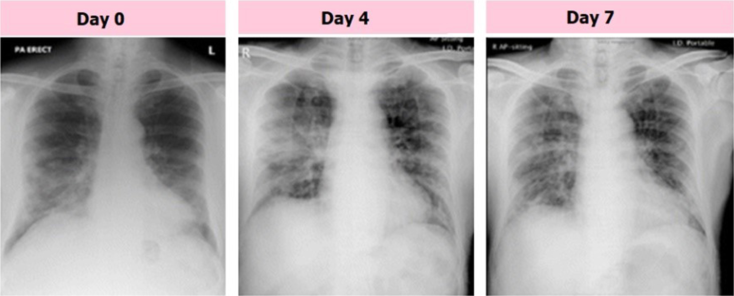 Samples of COVID-19 affected CXR images with GGO consolidation.
